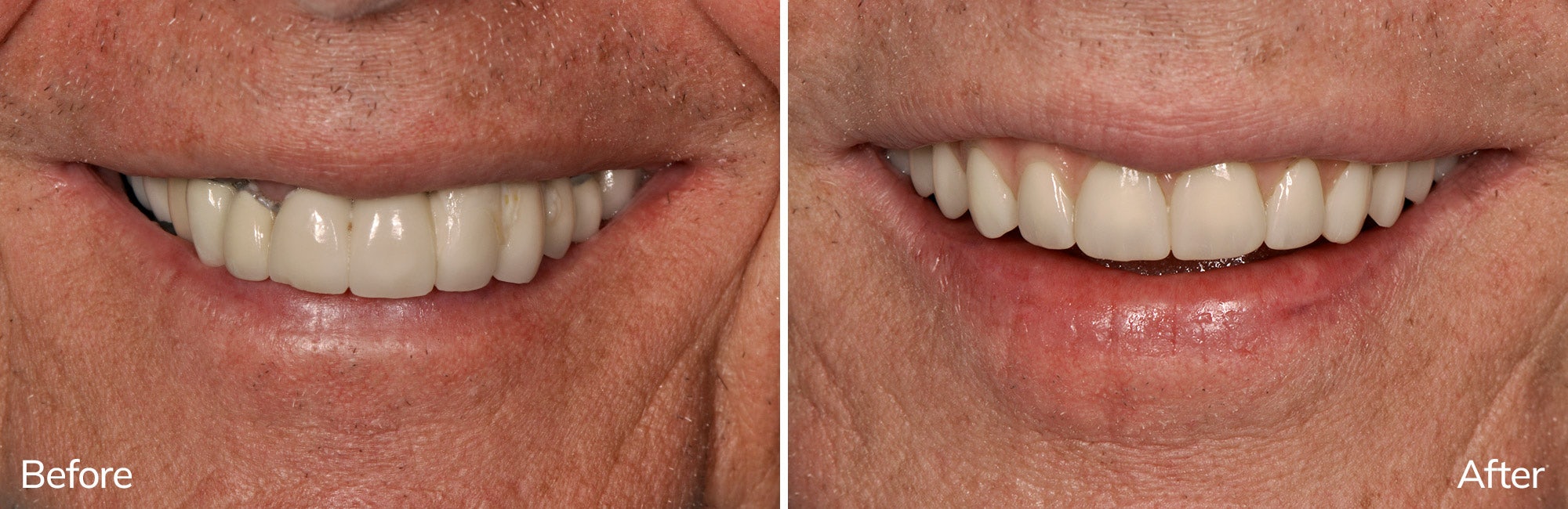 David's before and after full arch dental implants in Charlotte, NC