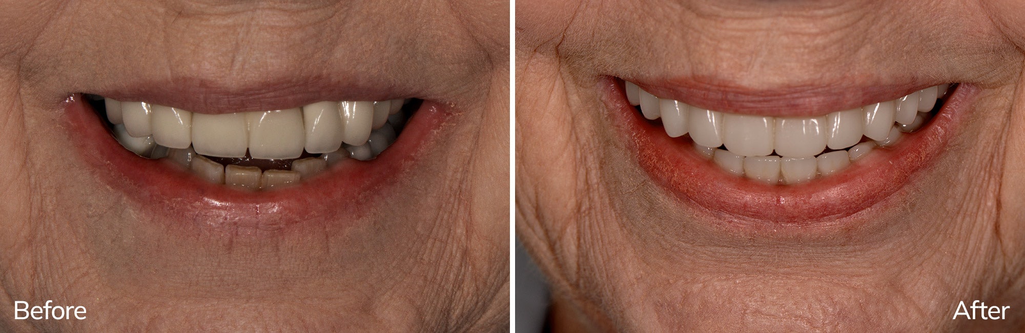 Marlene's before and after full arch dental implant transformation in Charlotte, NC