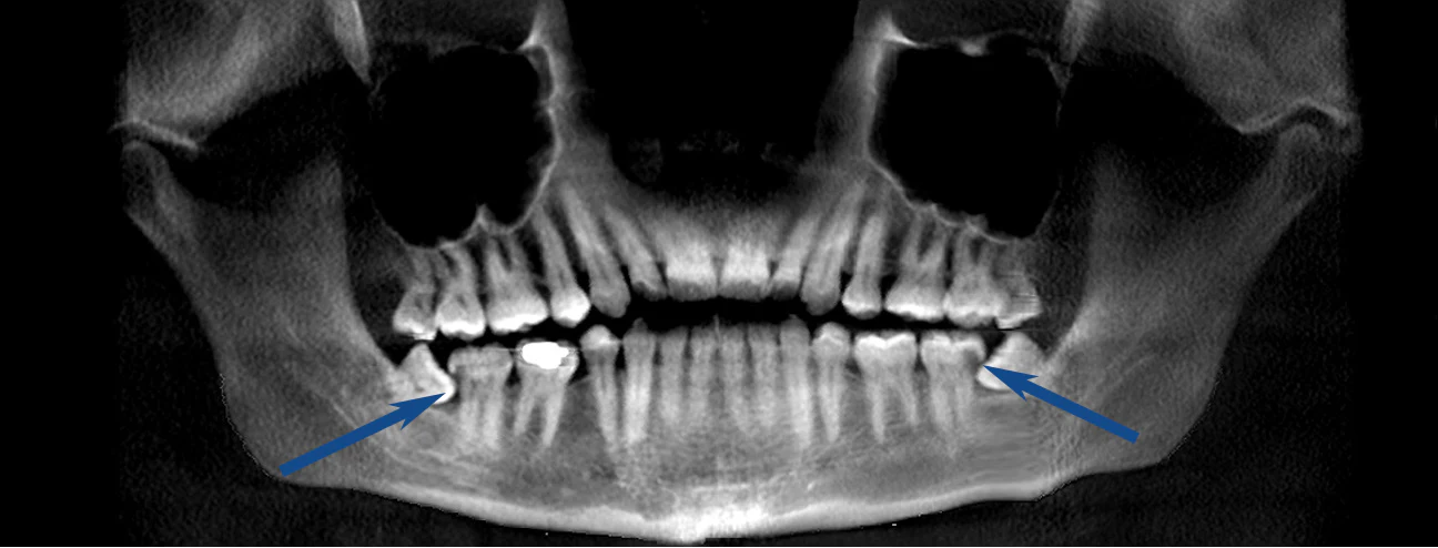 Wisdom Teeth Xray - Why get your wisdom teeth removed early