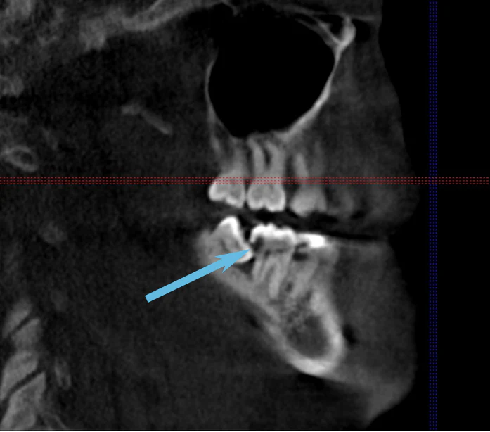 Wisdom Teeth Removal Xray