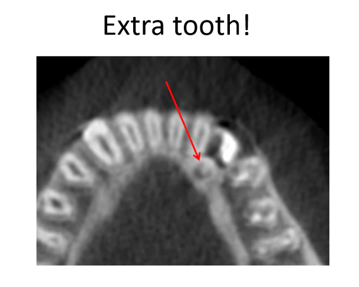 CBCT view identifying the extra tooth that was not visible on the original x-ray.