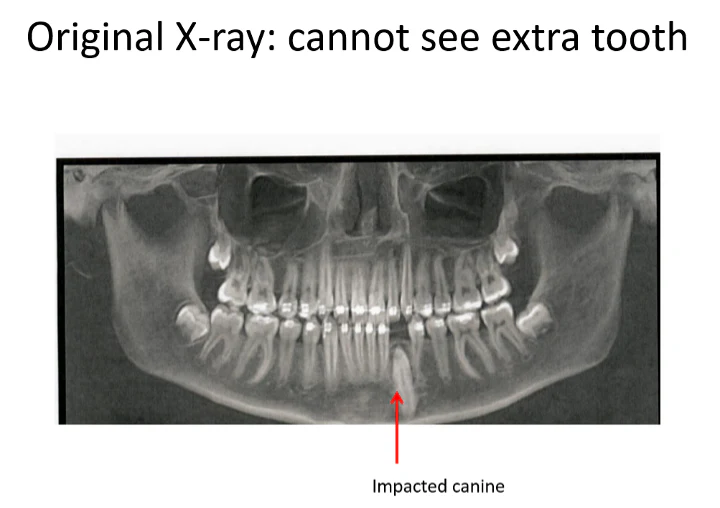 Original x-ray showing the impacted canine, without clearly revealing the extra tooth.