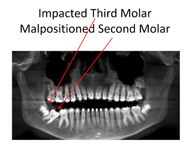 Panoramic Xâray of a 14âyearâold patient with an impacted wisdom tooth blocking the lower second molar from erupting into its normal position.