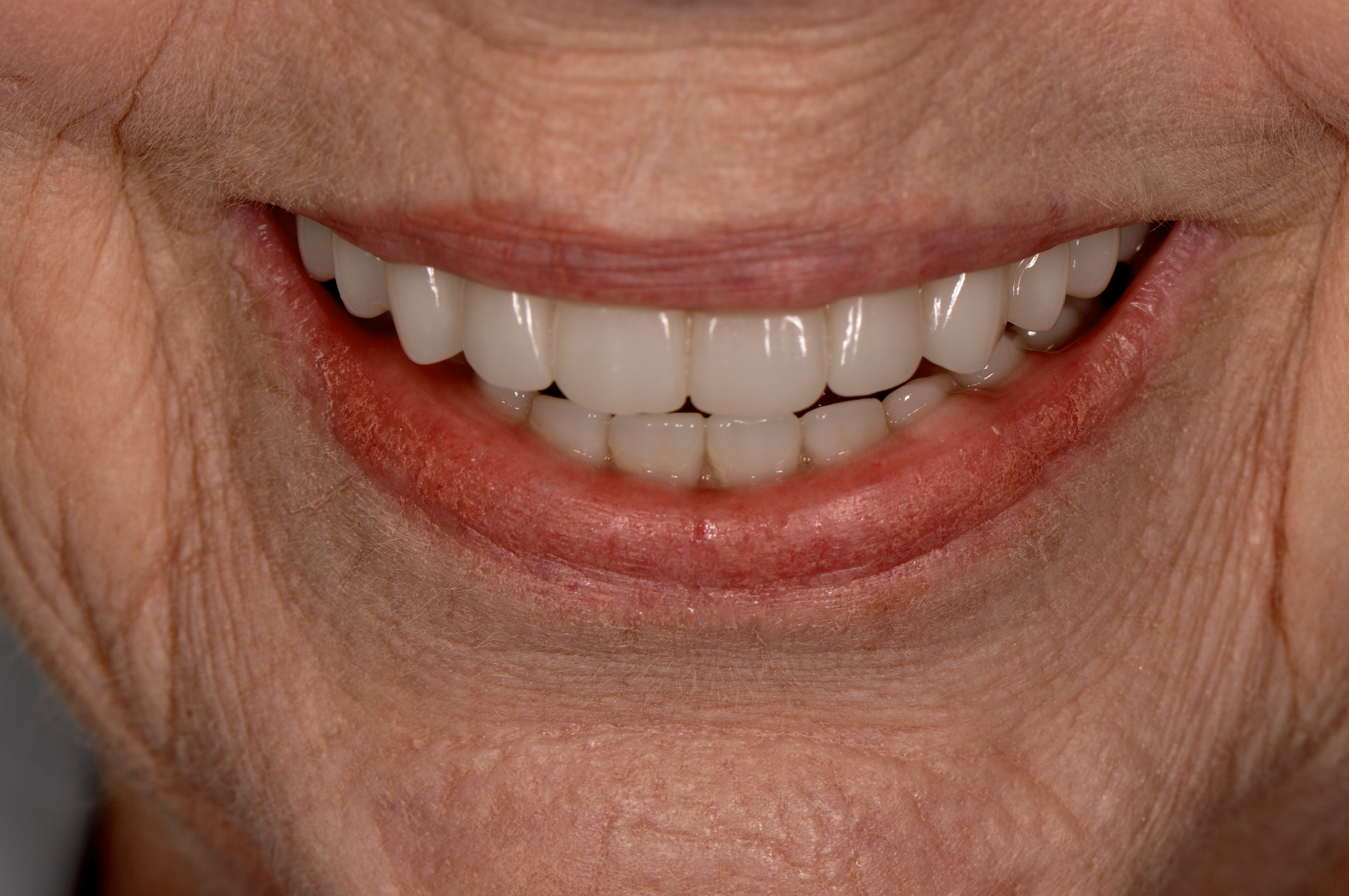 Dr. Dawson Full Arch Restoration - After