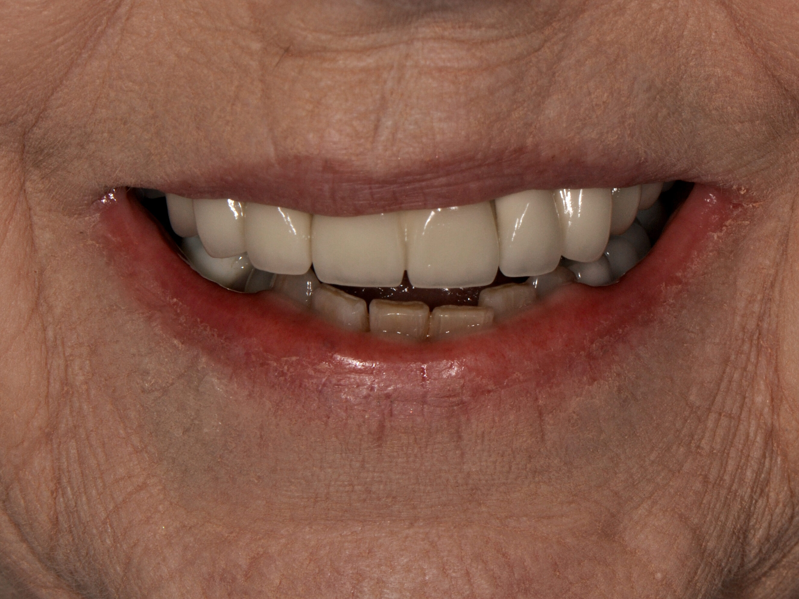 Dr. Dawson Full Arch Restoration - Before