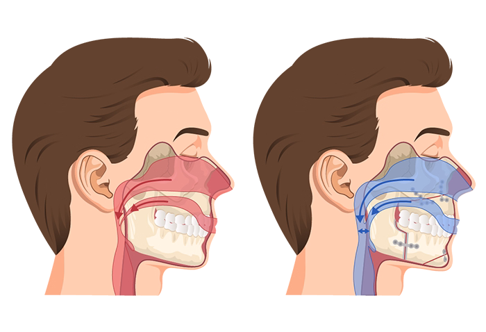Illustration of MMA jaw surgery to treat obstructive sleep apnea
