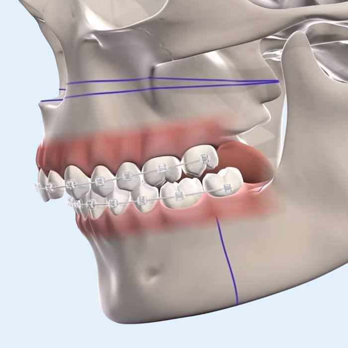Illustration of braces and jaw surgery plans