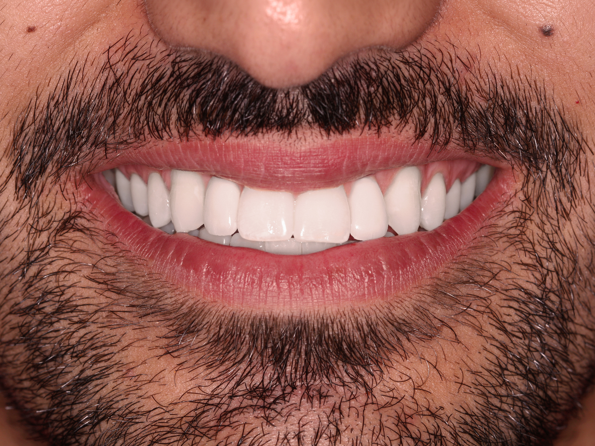Dental Implant After: Dr. Ryan Cook Envision Raleigh, NC
