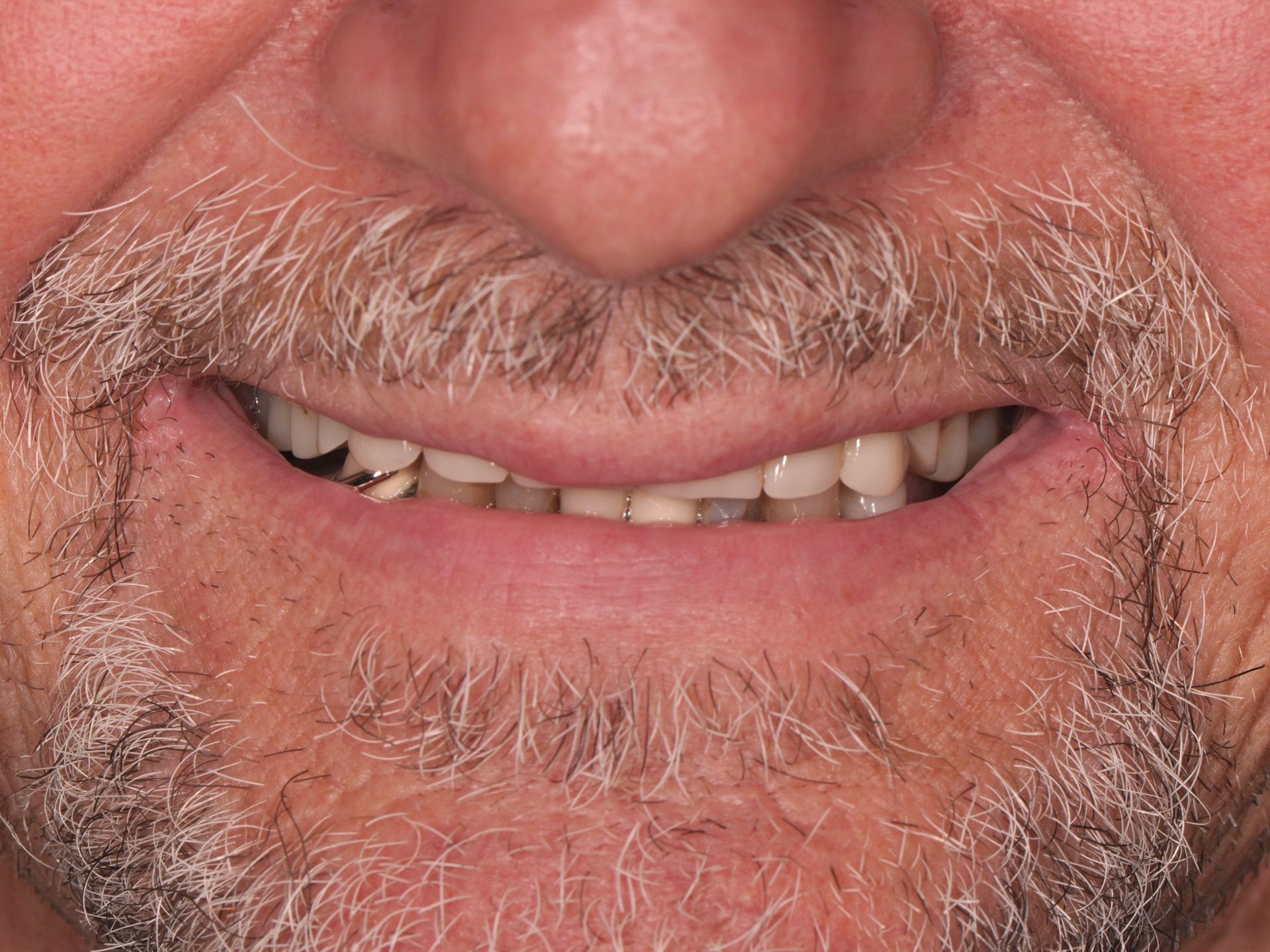 Dental Implant Before: Dr. Hunter Dawson Envision Charlotte, NC