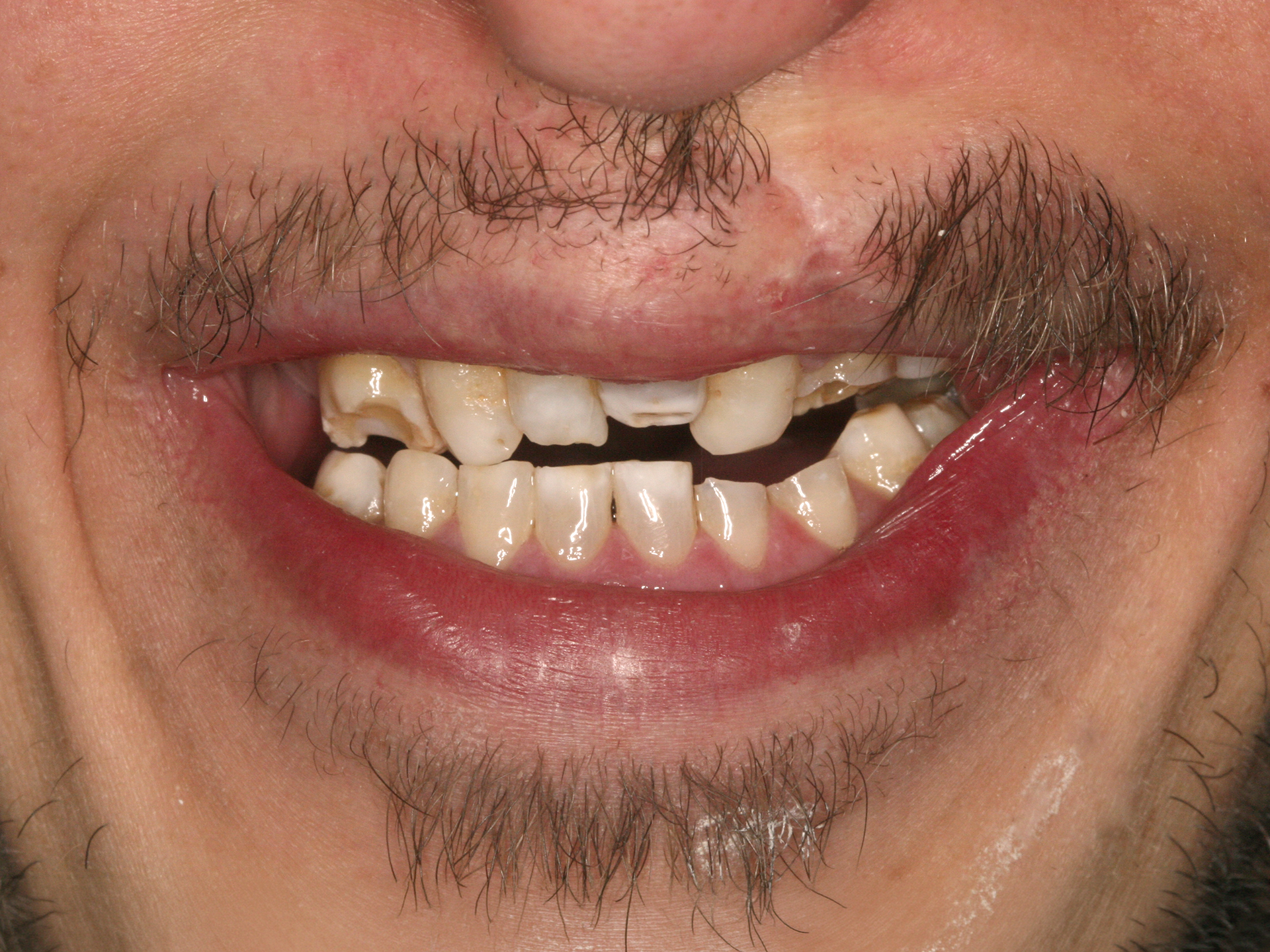 Dental Implant Before: Dr. Hunter Dawson Envision Charlotte, NC