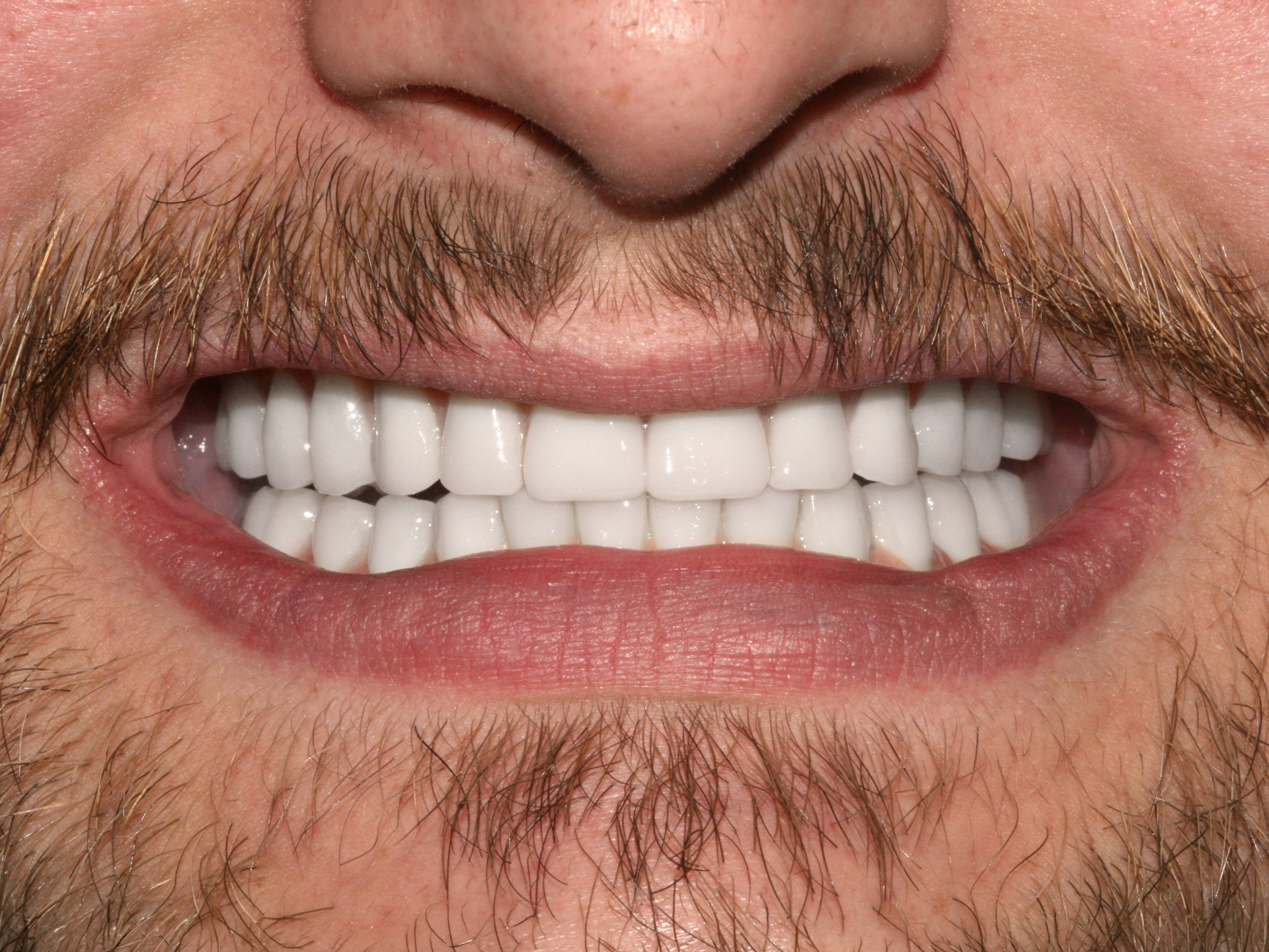 Dental Implant After: Dr. Hunter Dawson Envision Charlotte, NC
