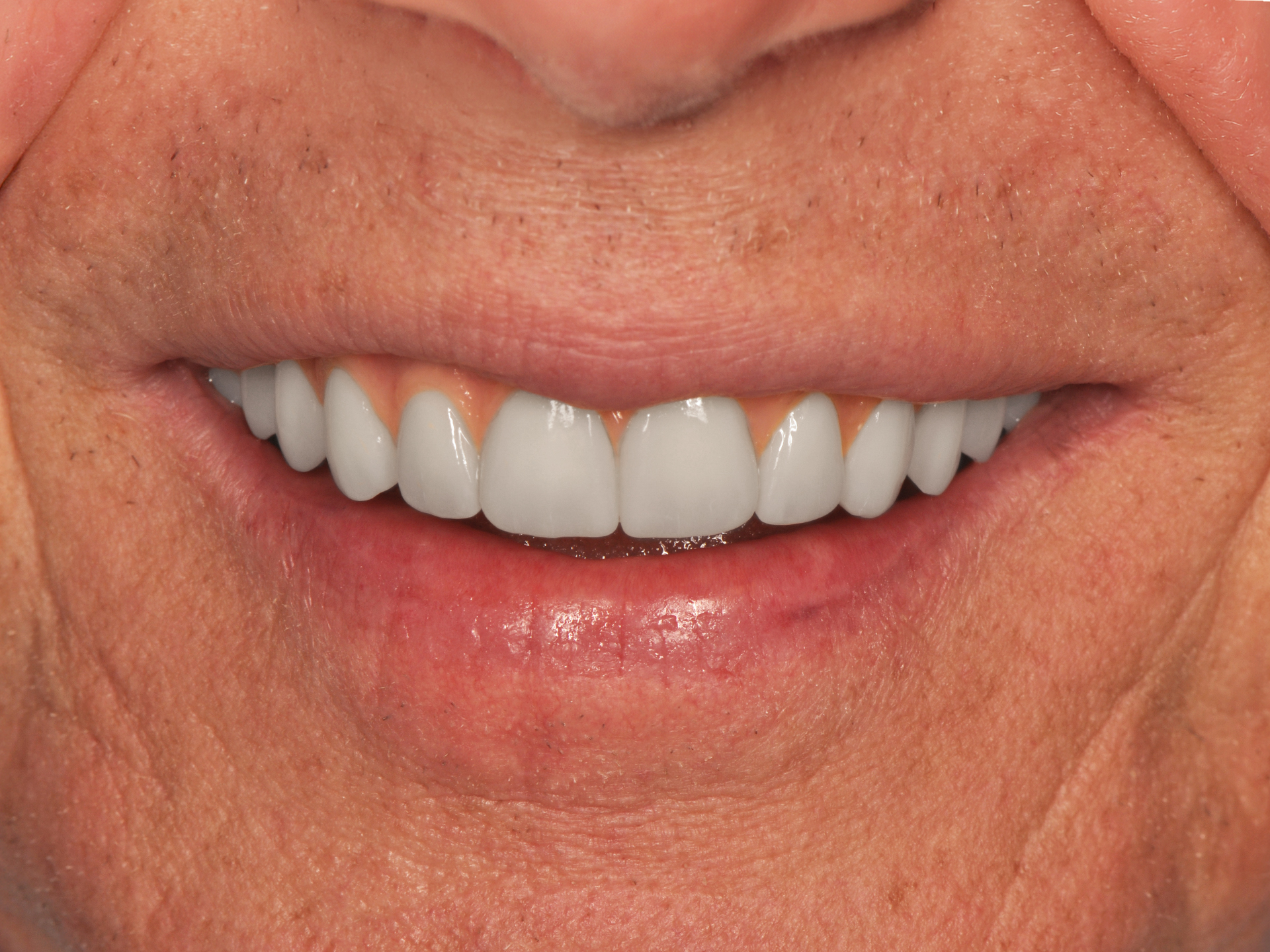 Dental Implant After: Dr. Hunter Dawson Envision Charlotte, NC