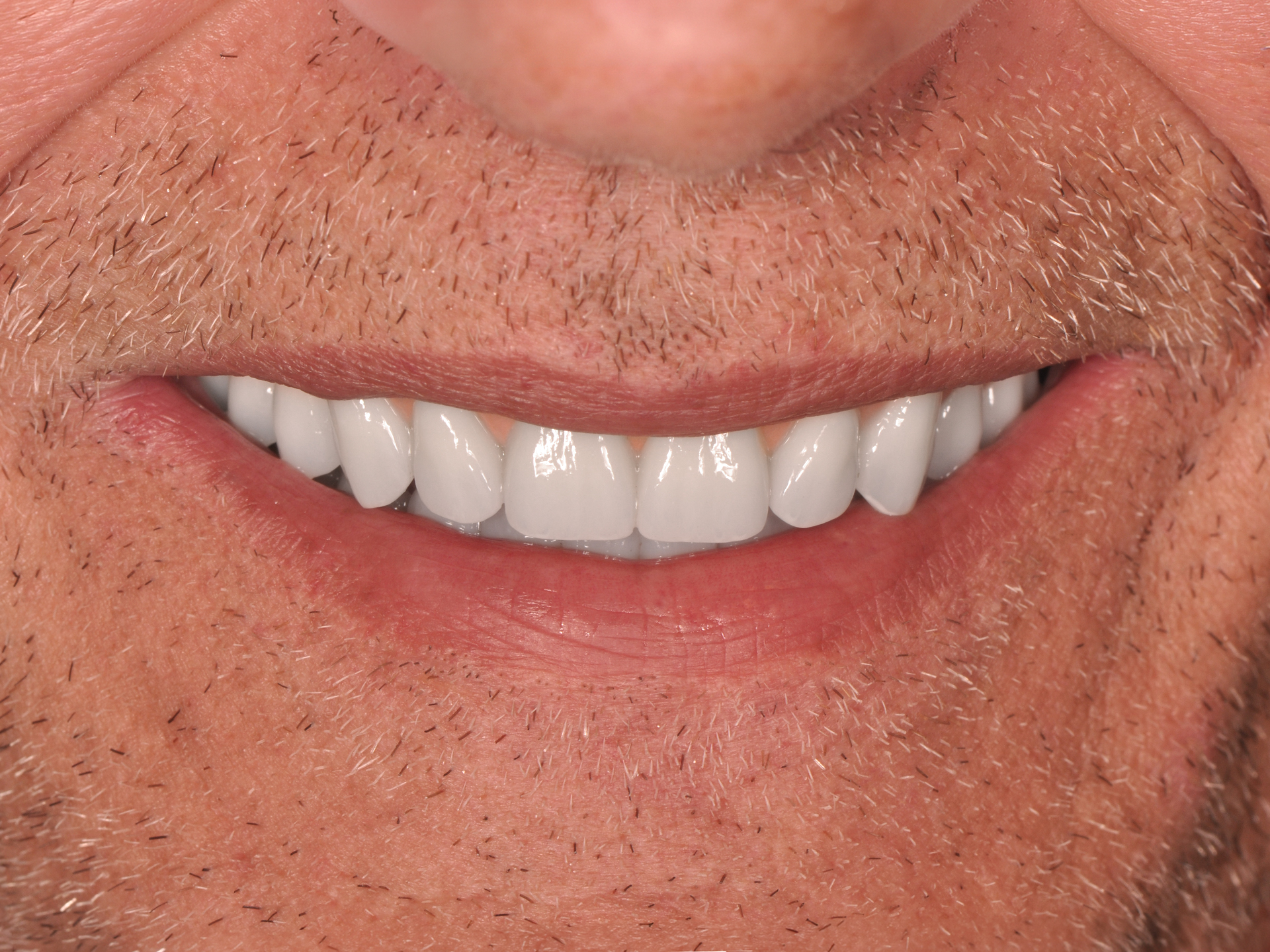 Dental Implant After: Dr. Hunter Dawson Envision Charlotte, NC