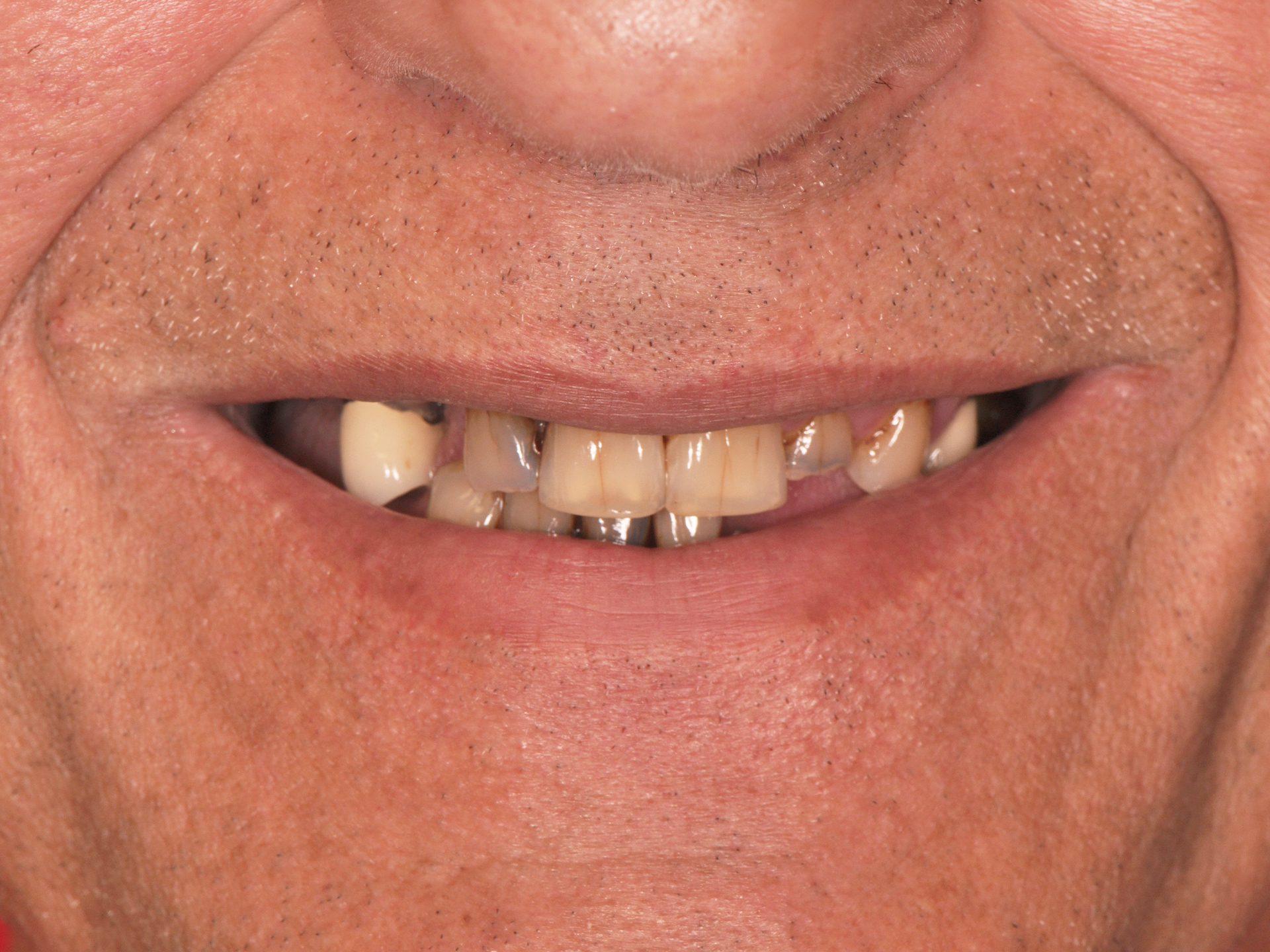 Dental Implant Before: Dr. Hunter Dawson Envision Charlotte, NC