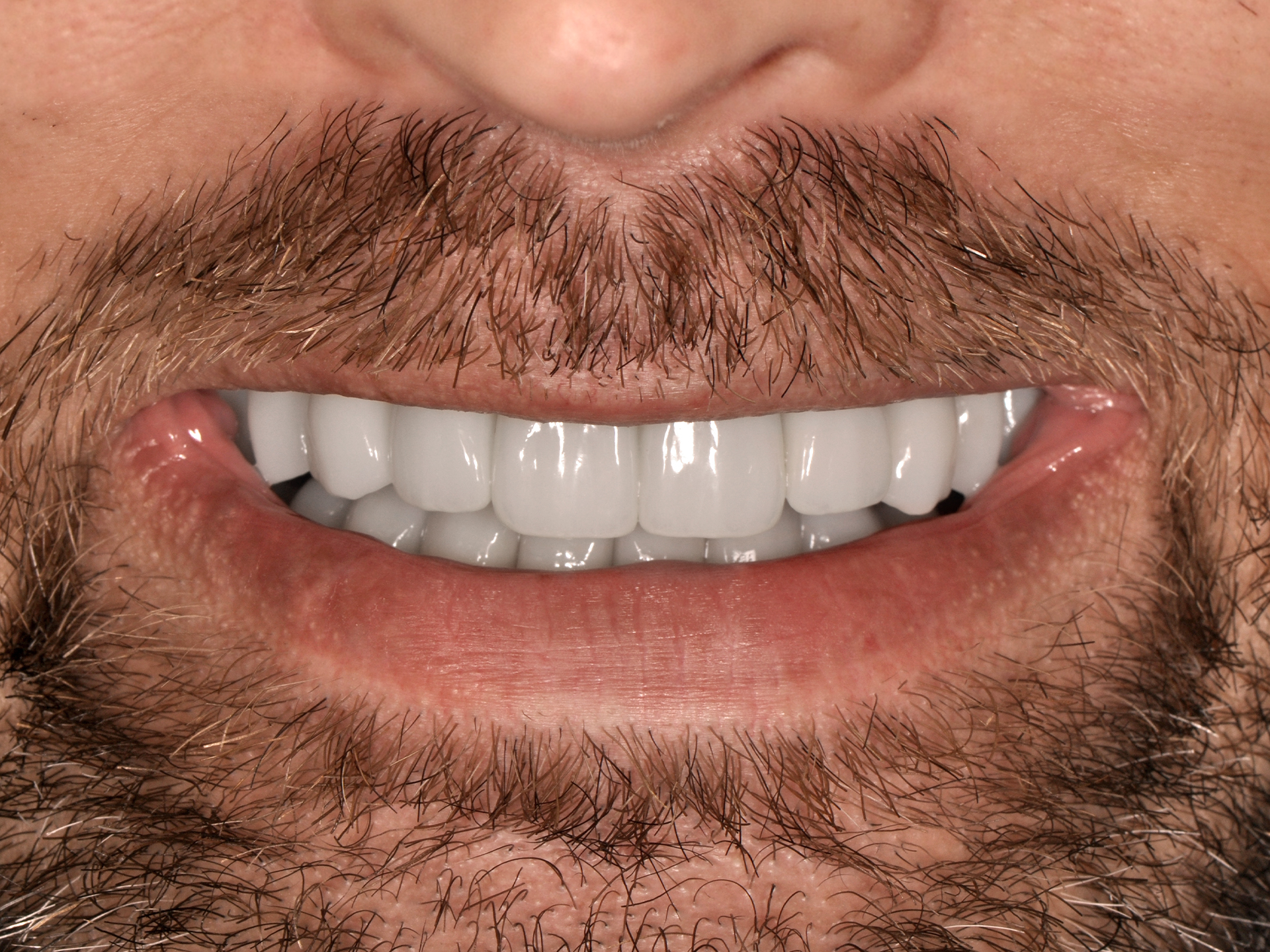 Dental Implant After: Dr. Hunter Dawson Envision Charlotte, NC