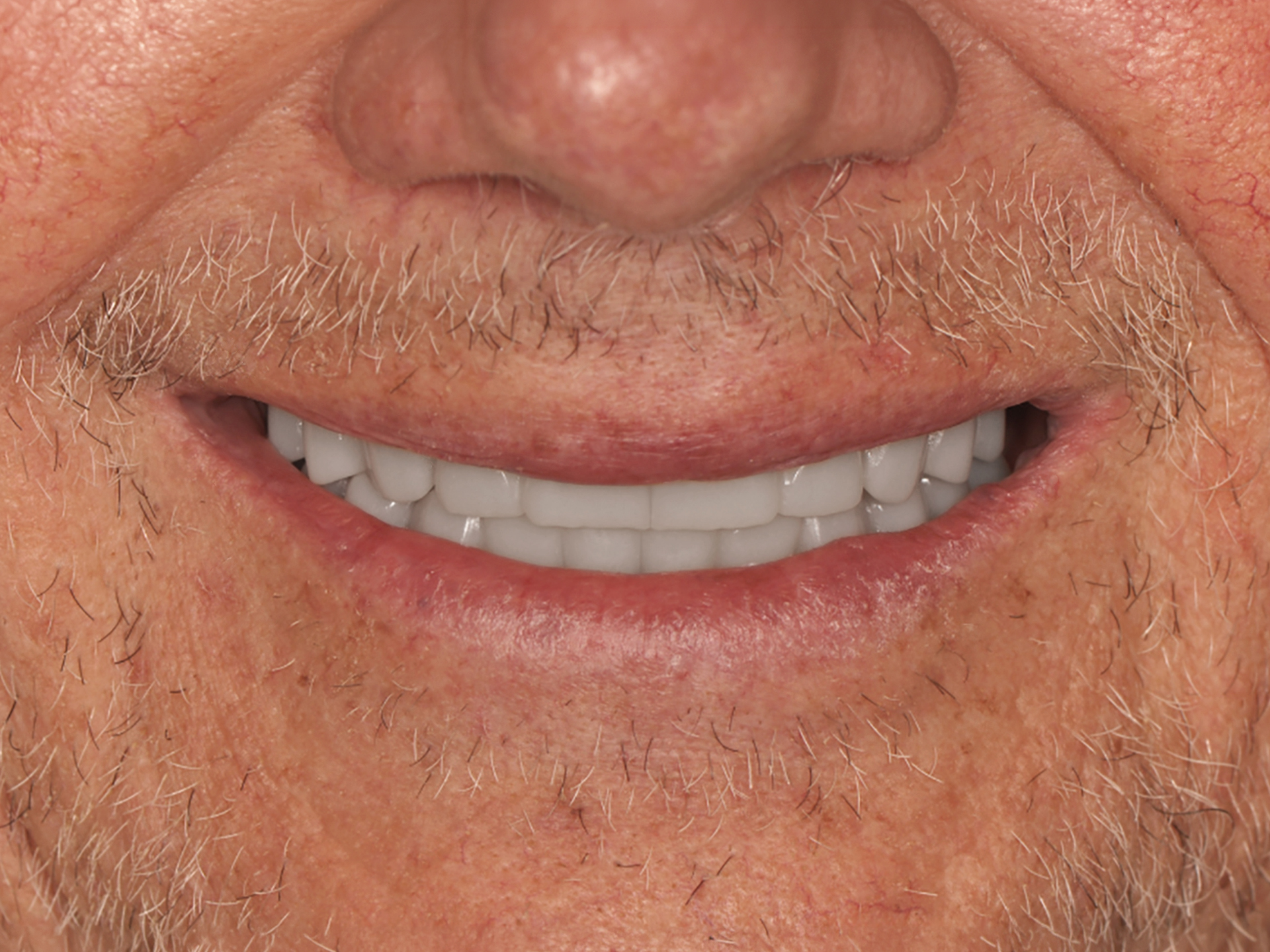 Dental Implant After: Dr. Hunter Dawson Envision Charlotte, NC