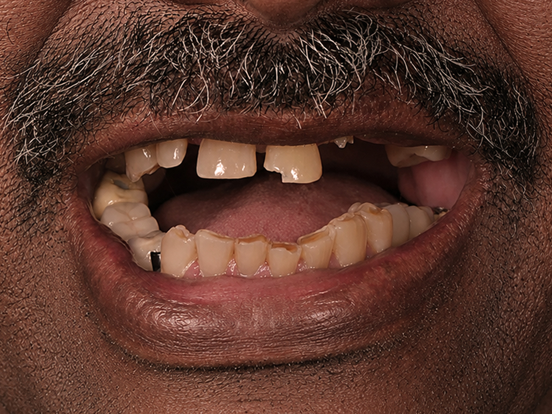 Dental Implant Before: Dr. Hunter Dawson Envision Charlotte, NC
