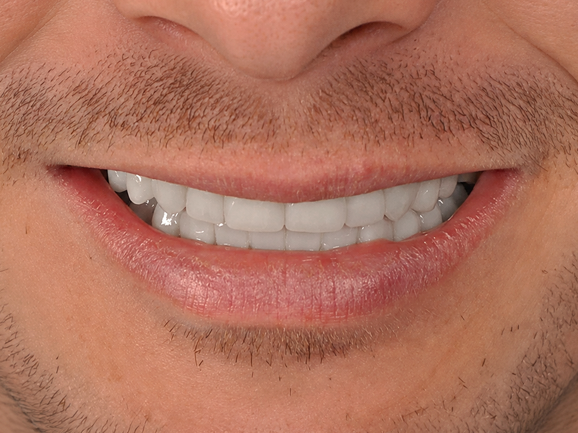 Dental Implant After: Dr. Hunter Dawson Envision Charlotte, NC