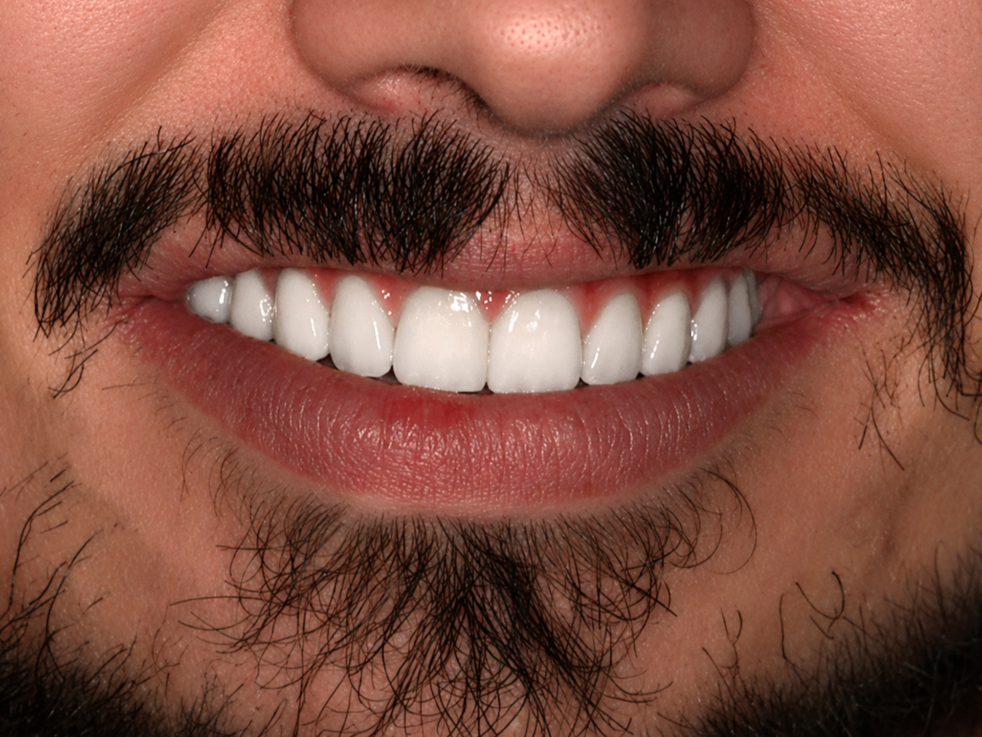 Dental Implant After: Dr. Hunter Dawson Envision Charlotte, NC