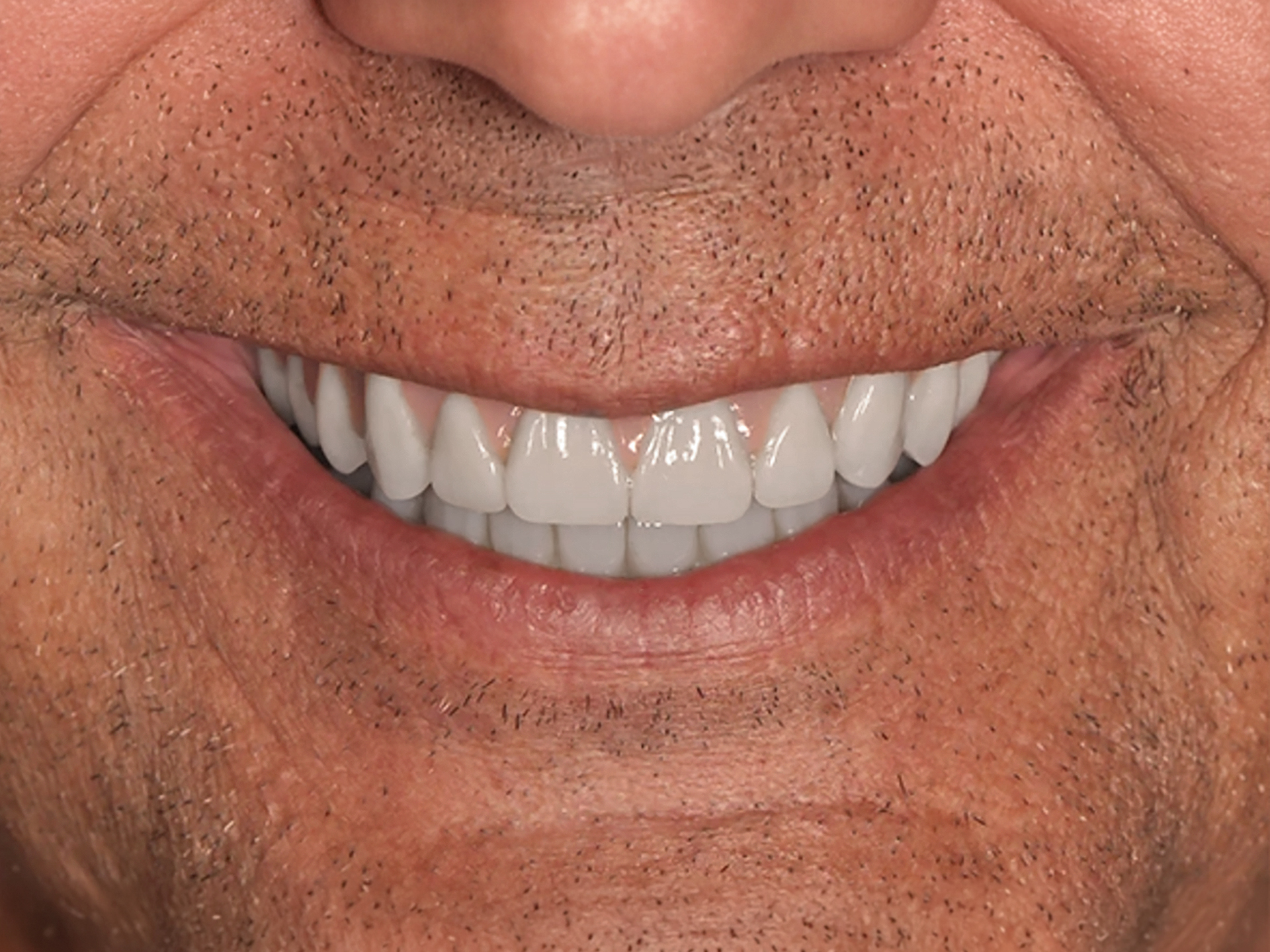 Dental Implant After: Dr. Hunter Dawson Envision Charlotte, NC