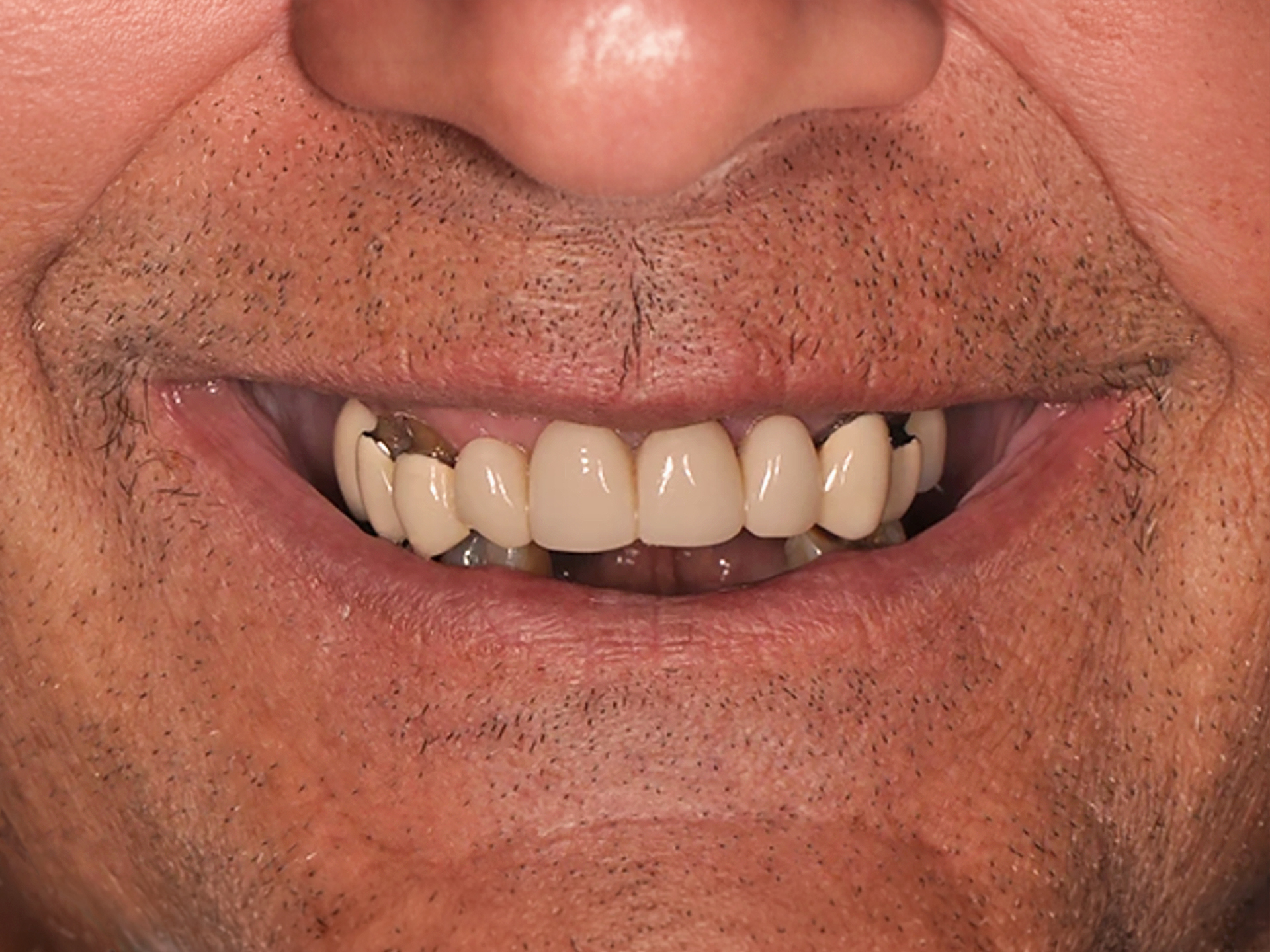 Dental Implant Before: Dr. Hunter Dawson Envision Charlotte, NC