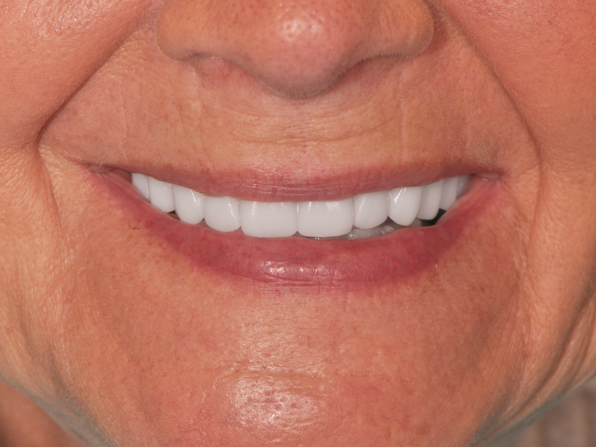 Dental Implant After: Dr. Hunter Dawson Envision Charlotte, NC
