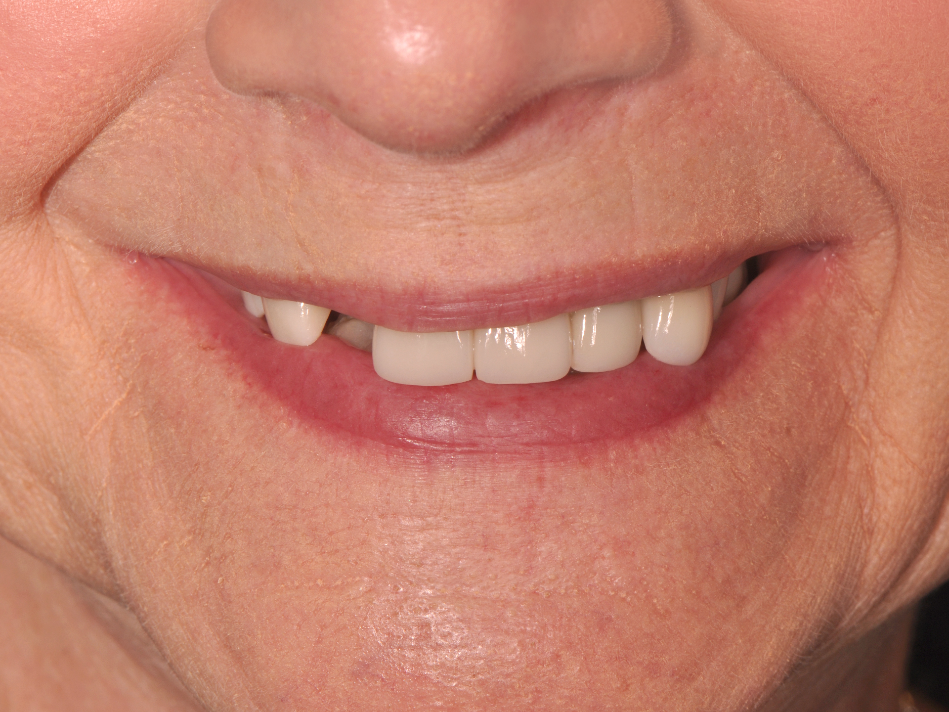 Dental Implant Before: Dr. Hunter Dawson Envision Charlotte, NC