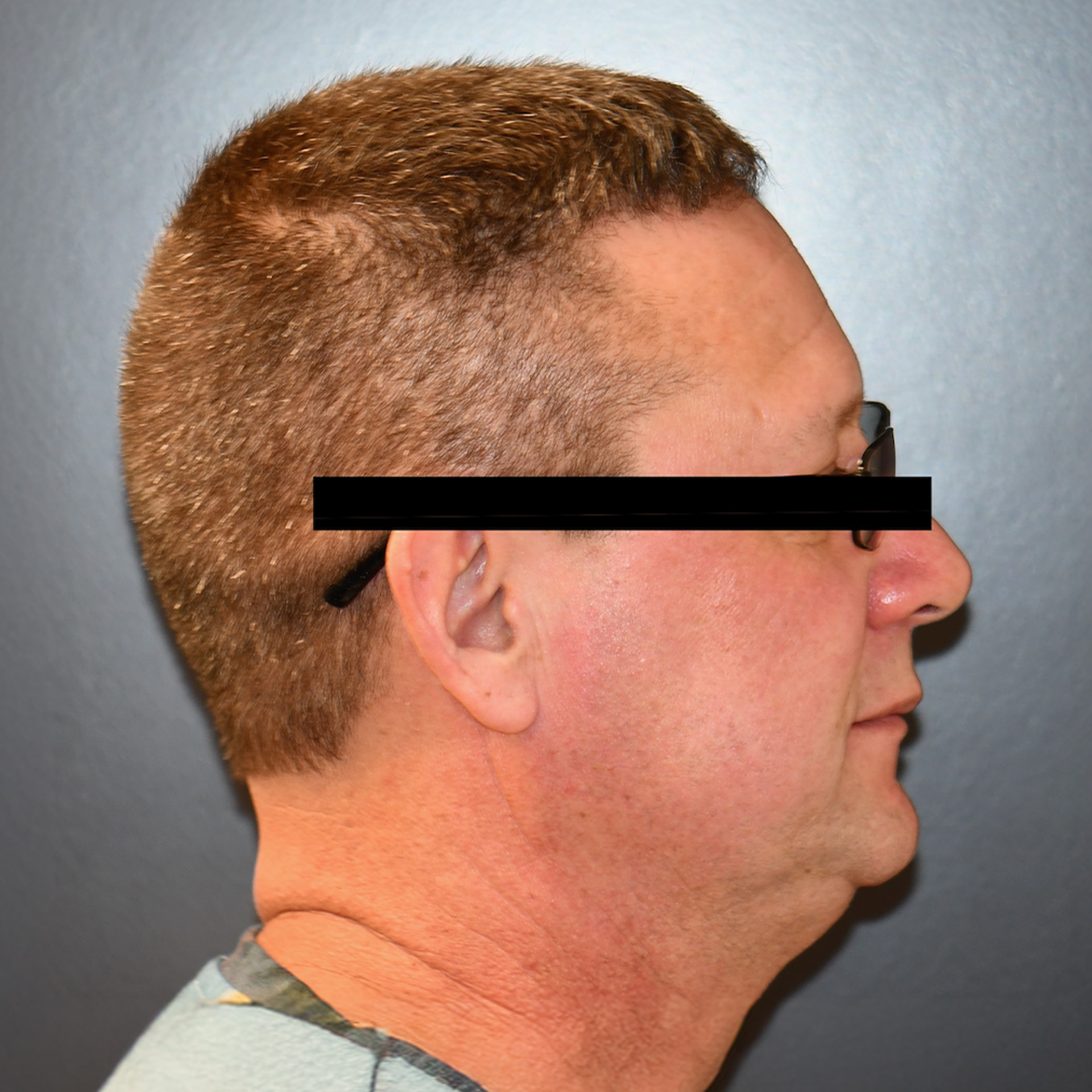 Jaw Surgery Before: Dr. Chad Dammling - CCOFS - Raleigh, NC