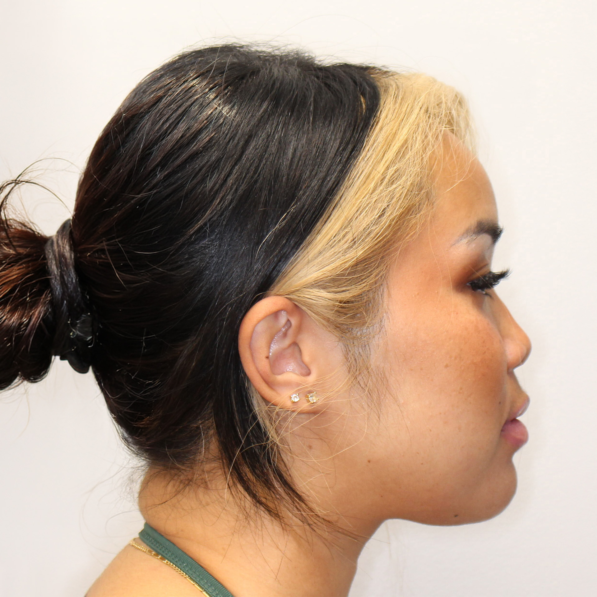Jaw Surgery After: Dr Peter Franco - CCOFS - Charlotte, NC