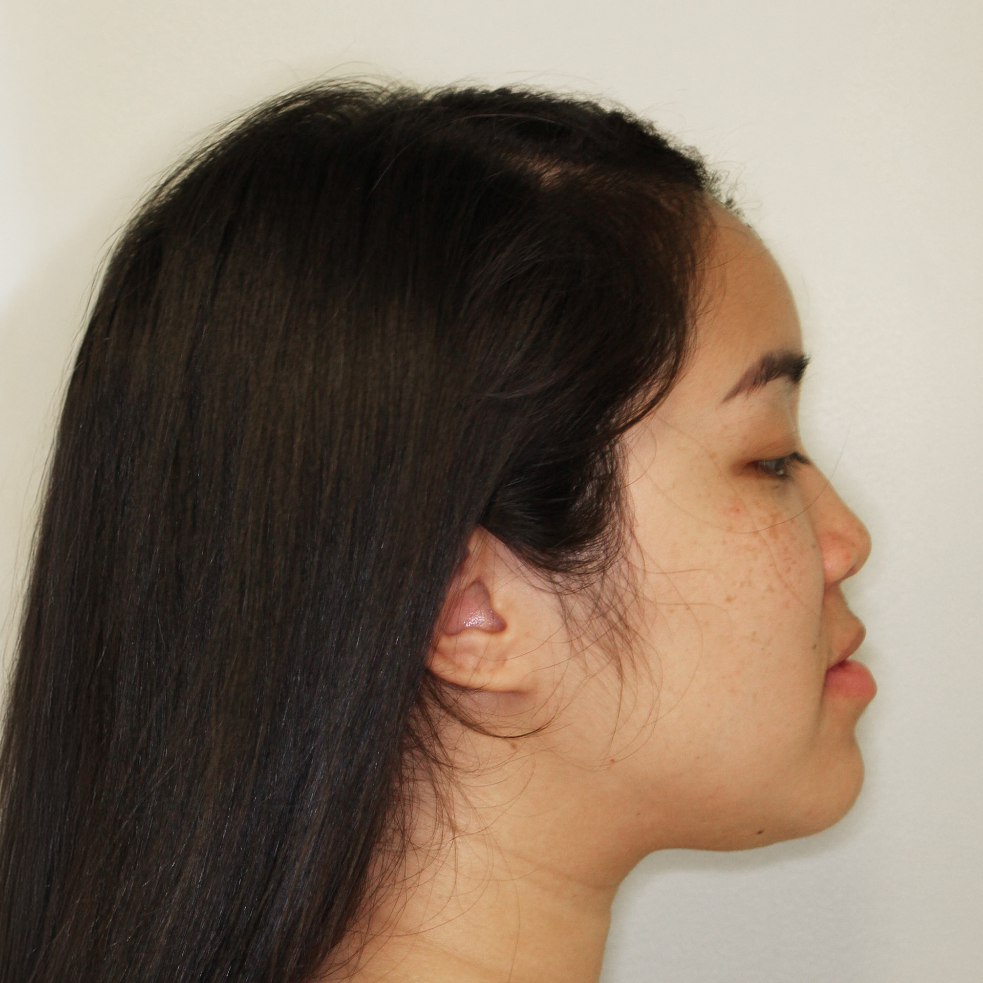 Jaw Surgery Before: Dr. Peter Franco - CCOFS - Charlotte, NC