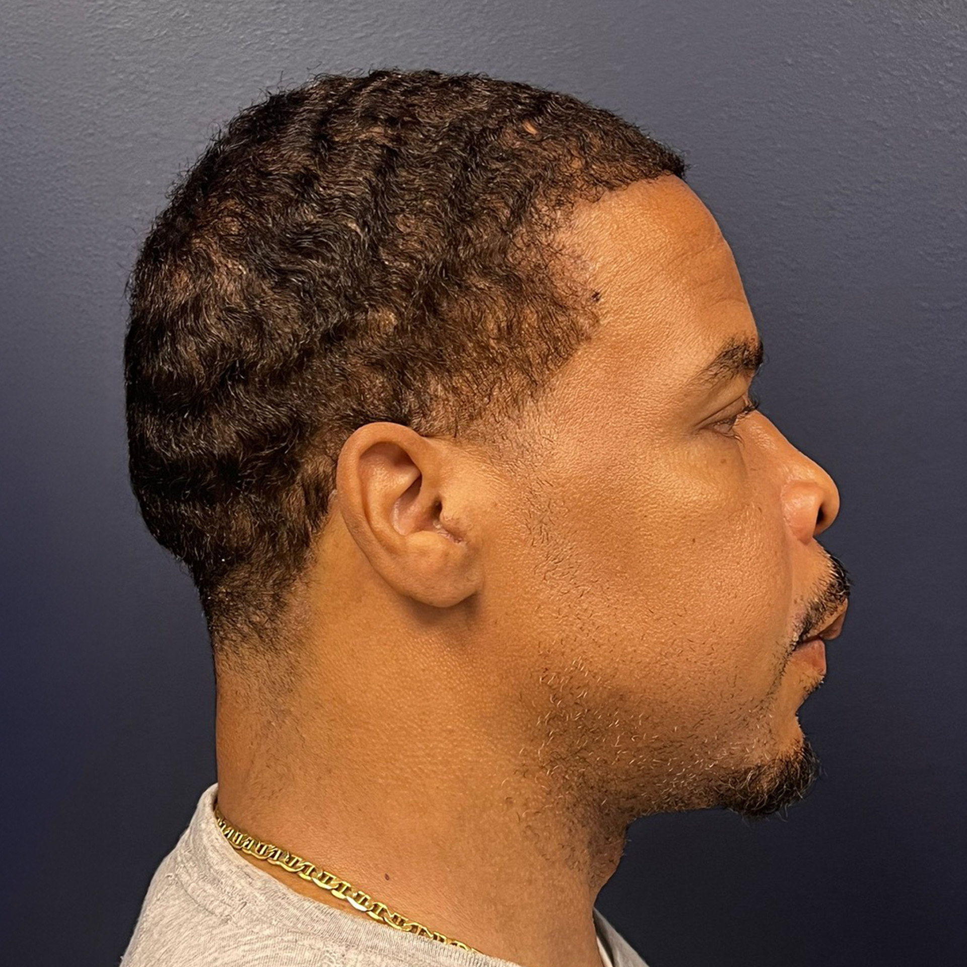 Jaw Surgery After: Dr Roger Moreira - CCOFS - Raleigh, NC
