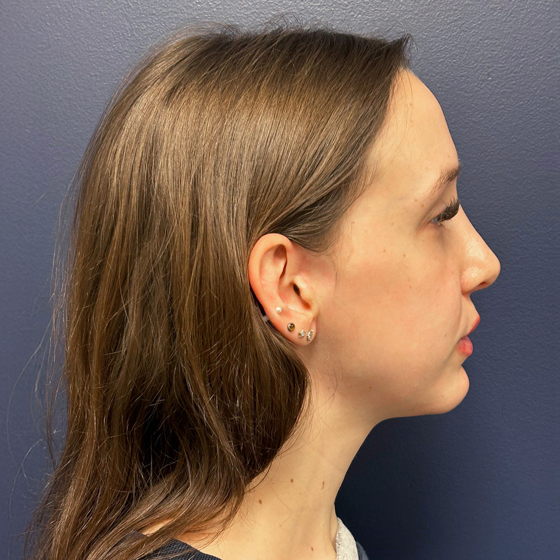 Jaw Surgery After: Dr Roger Moreira - CCOFS - Raleigh, NC