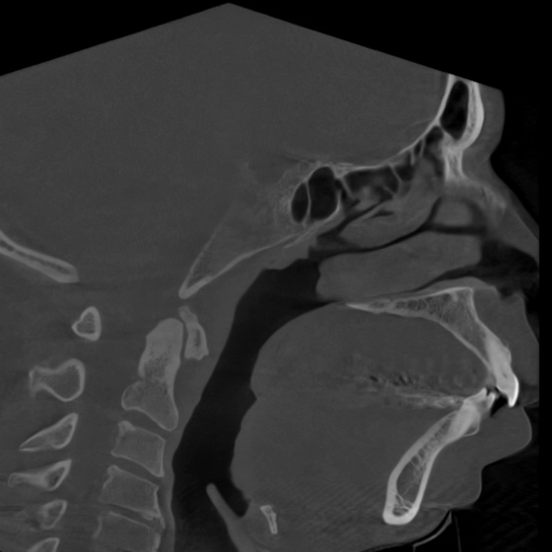 Jaw Surgery Before: Dr Roger Moreira - CCOFS - Raleigh, NC