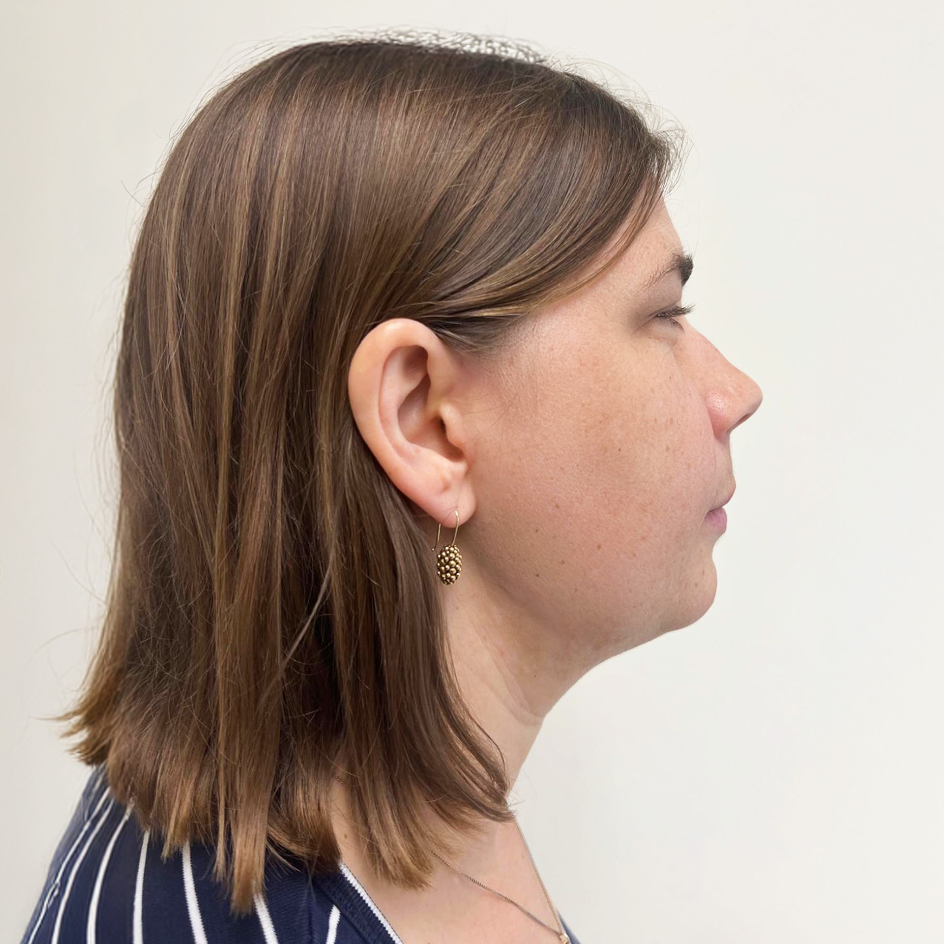 Jaw Surgery After: Dr Roger Moreira - CCOFS - Raleigh, NC