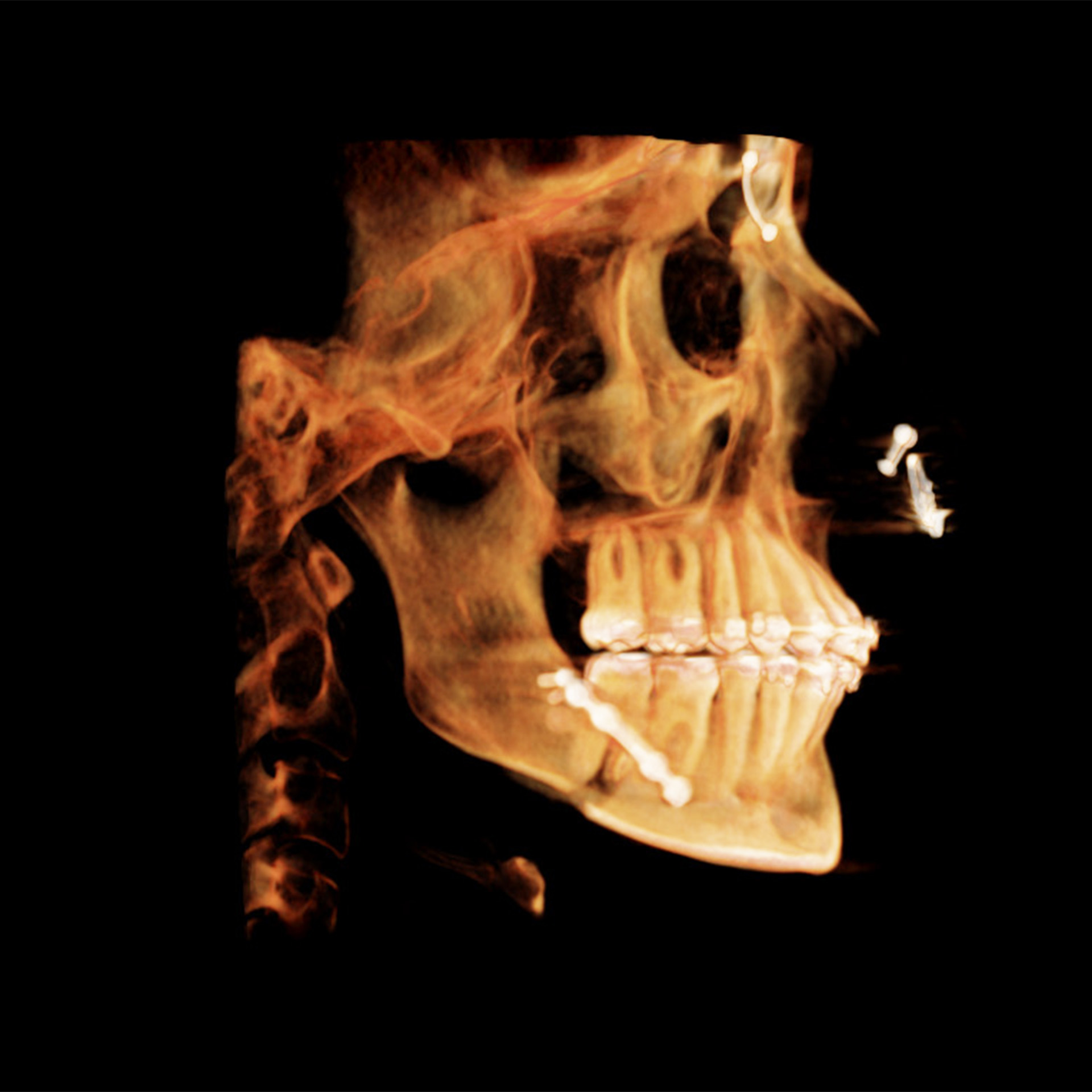 Jaw Surgery After: Dr. Matthew Pham - CCOFS - Columbia, SC