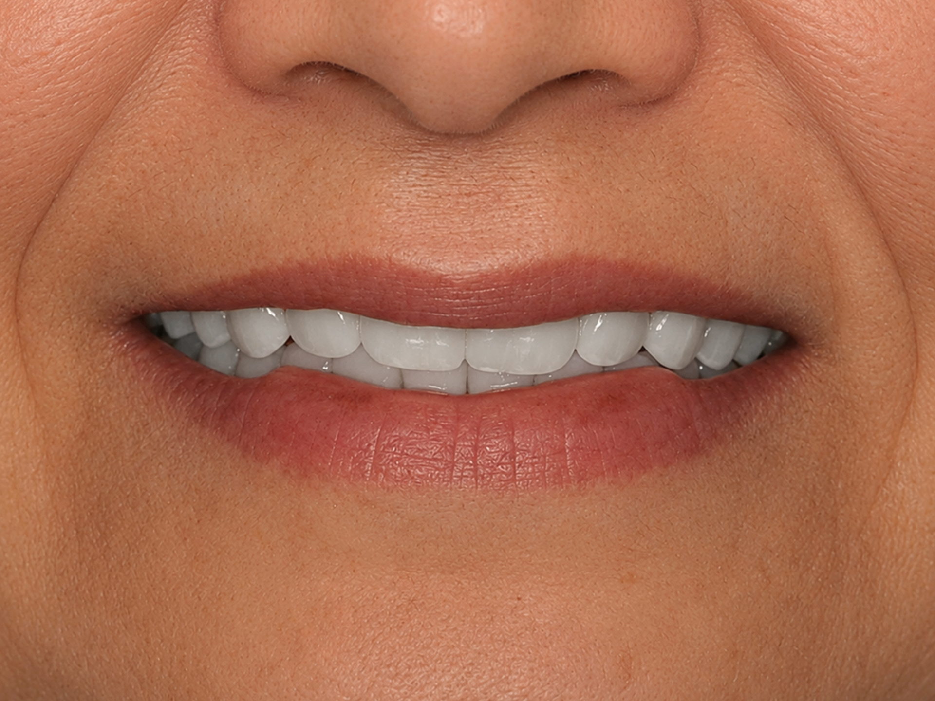 Dental Implant Before: Dr. Hunter Dawson Envision Charlotte, NC
