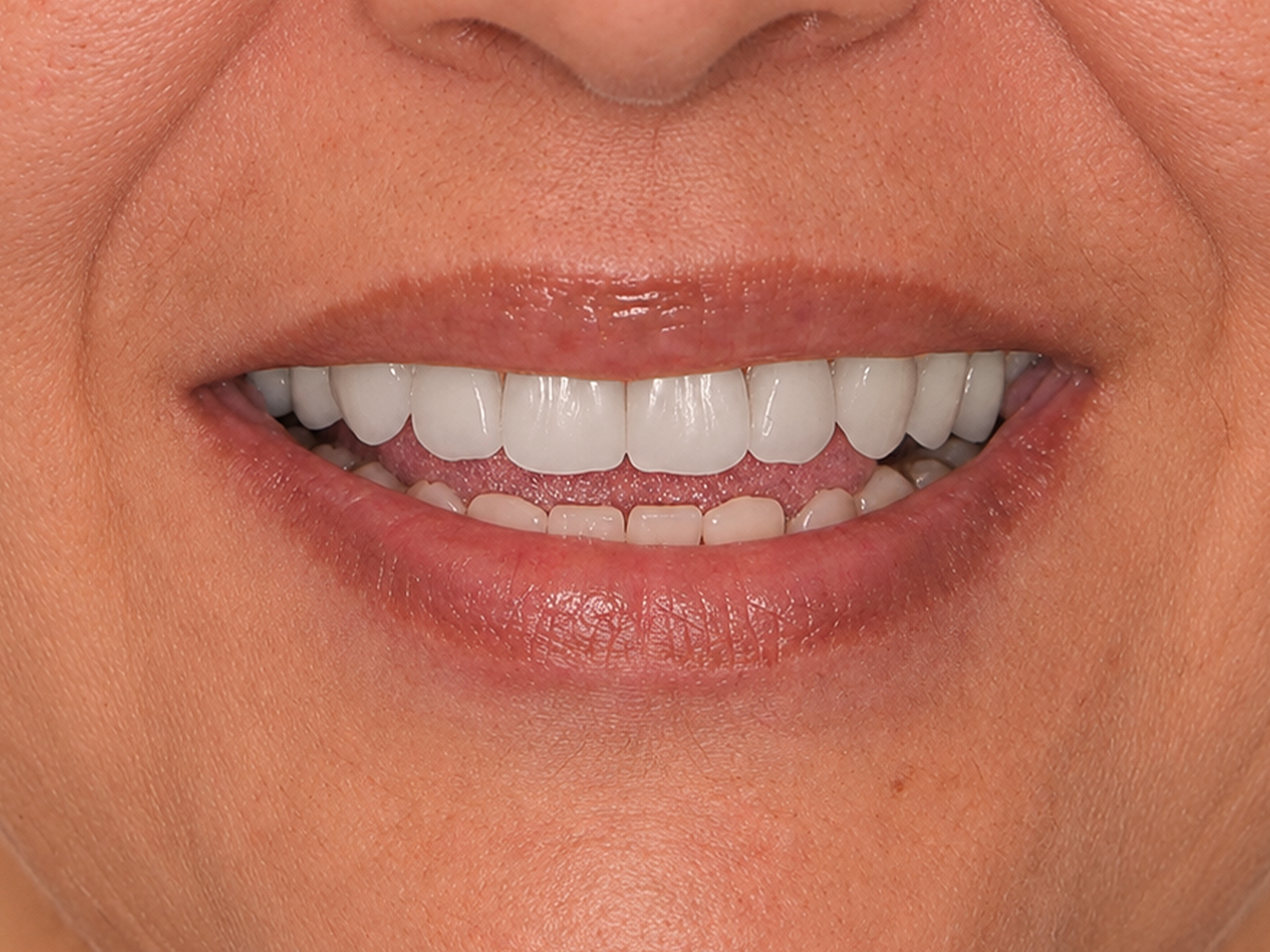 Dental Implant After: Dr. Hunter Dawson Envision Charlotte, NC