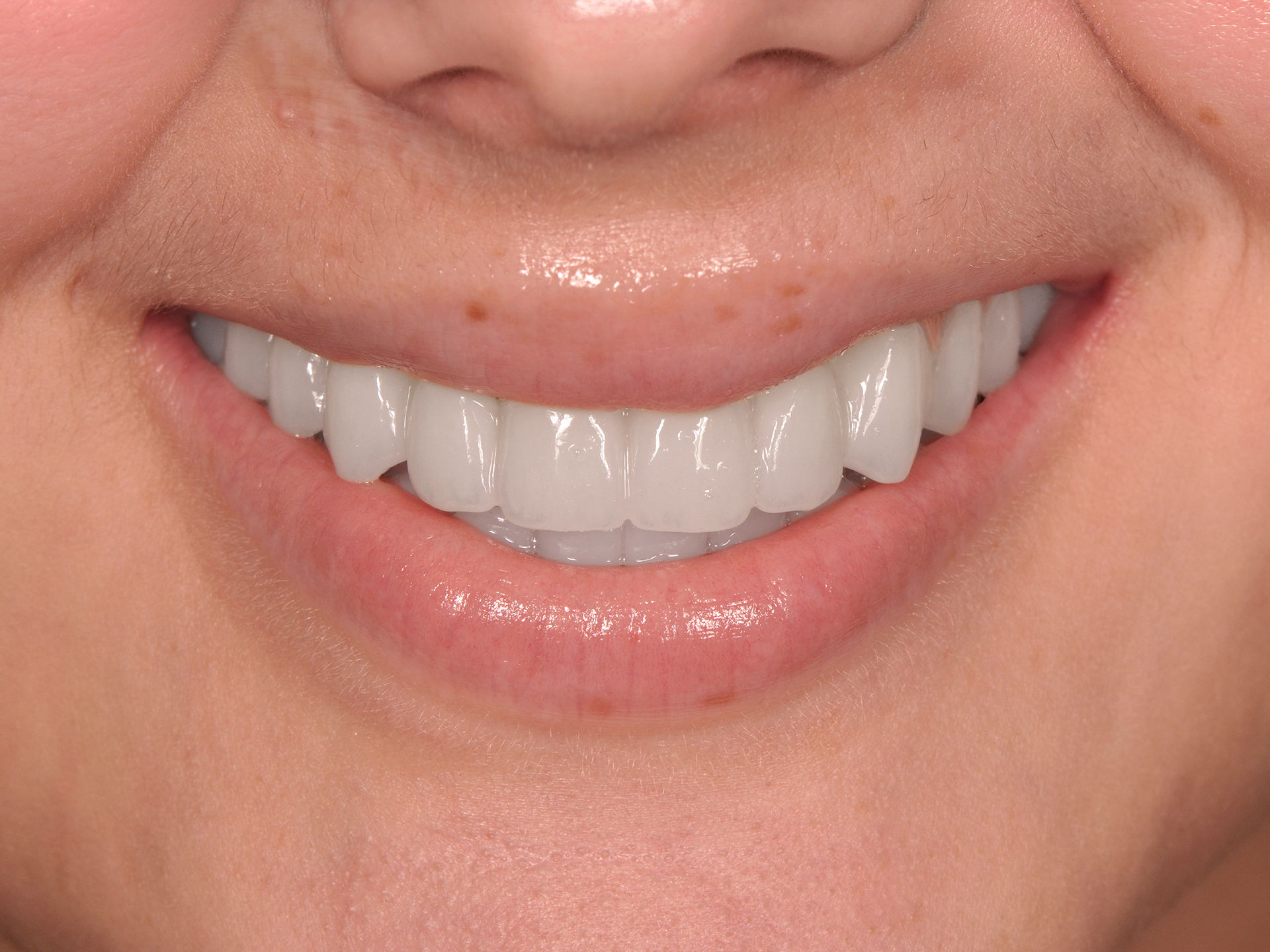 Dental Implant After: Dr. Hunter Dawson Envision Charlotte, NC