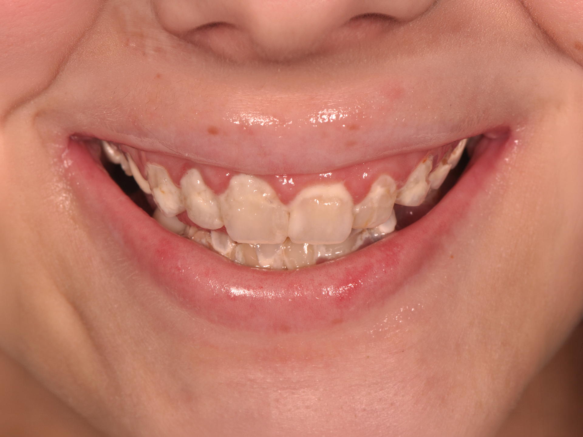 Dental Implant Before: Dr. Hunter Dawson Envision Charlotte NC