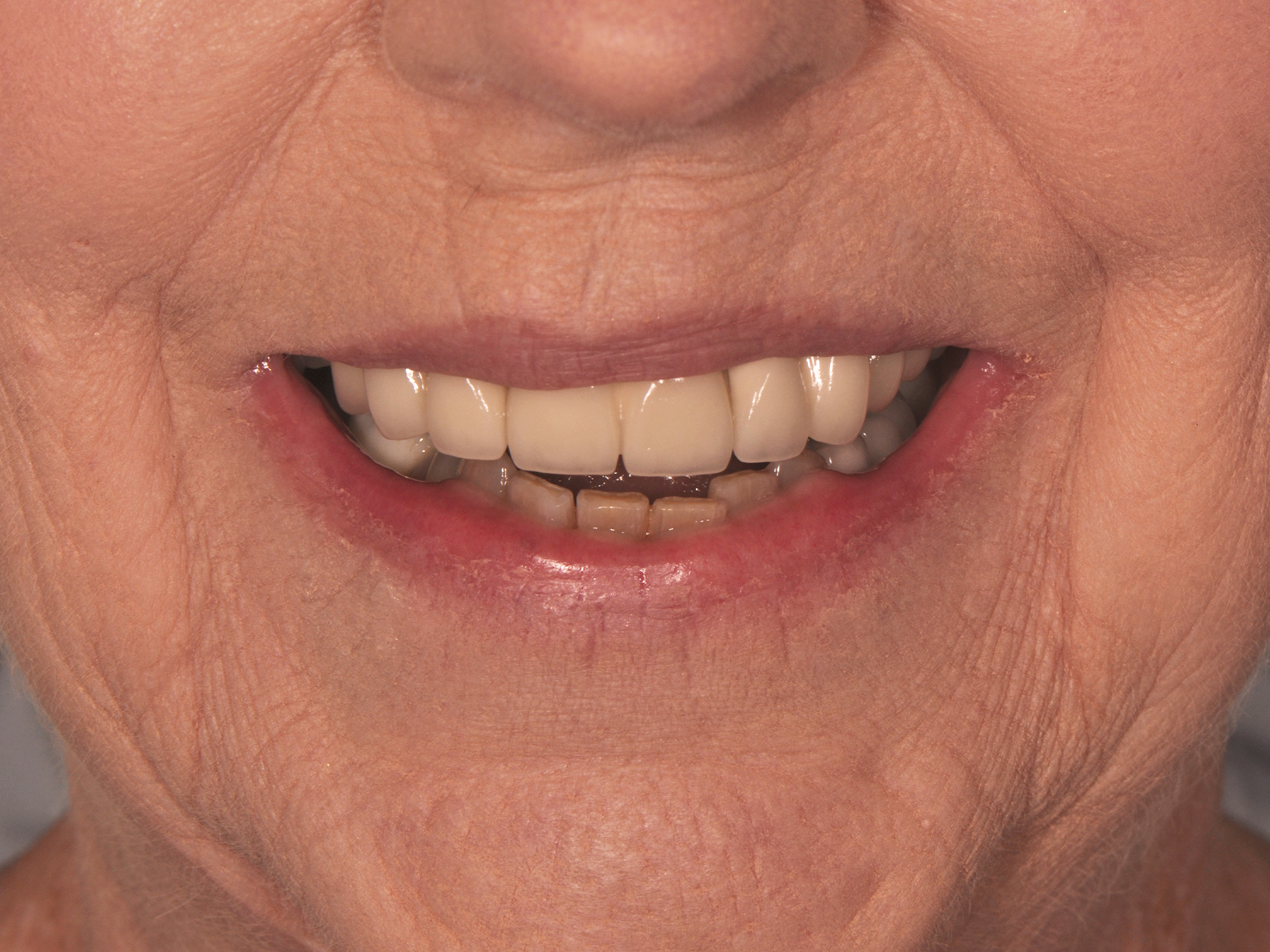 Dental Implant Before