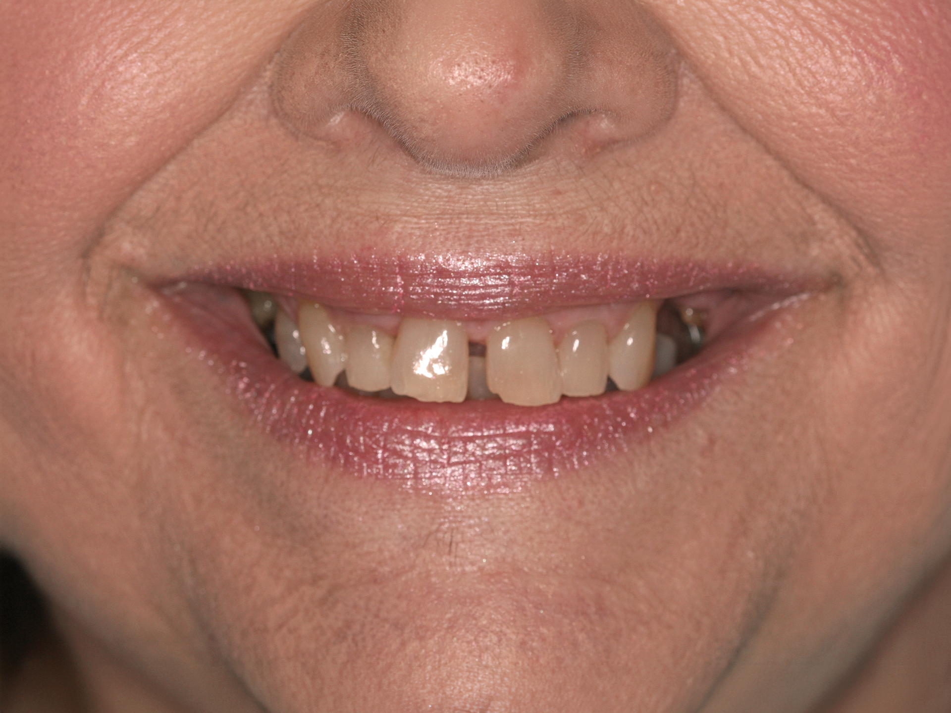 Dental Implant Before: Dr. Craig Horton Envision Greenville, SC