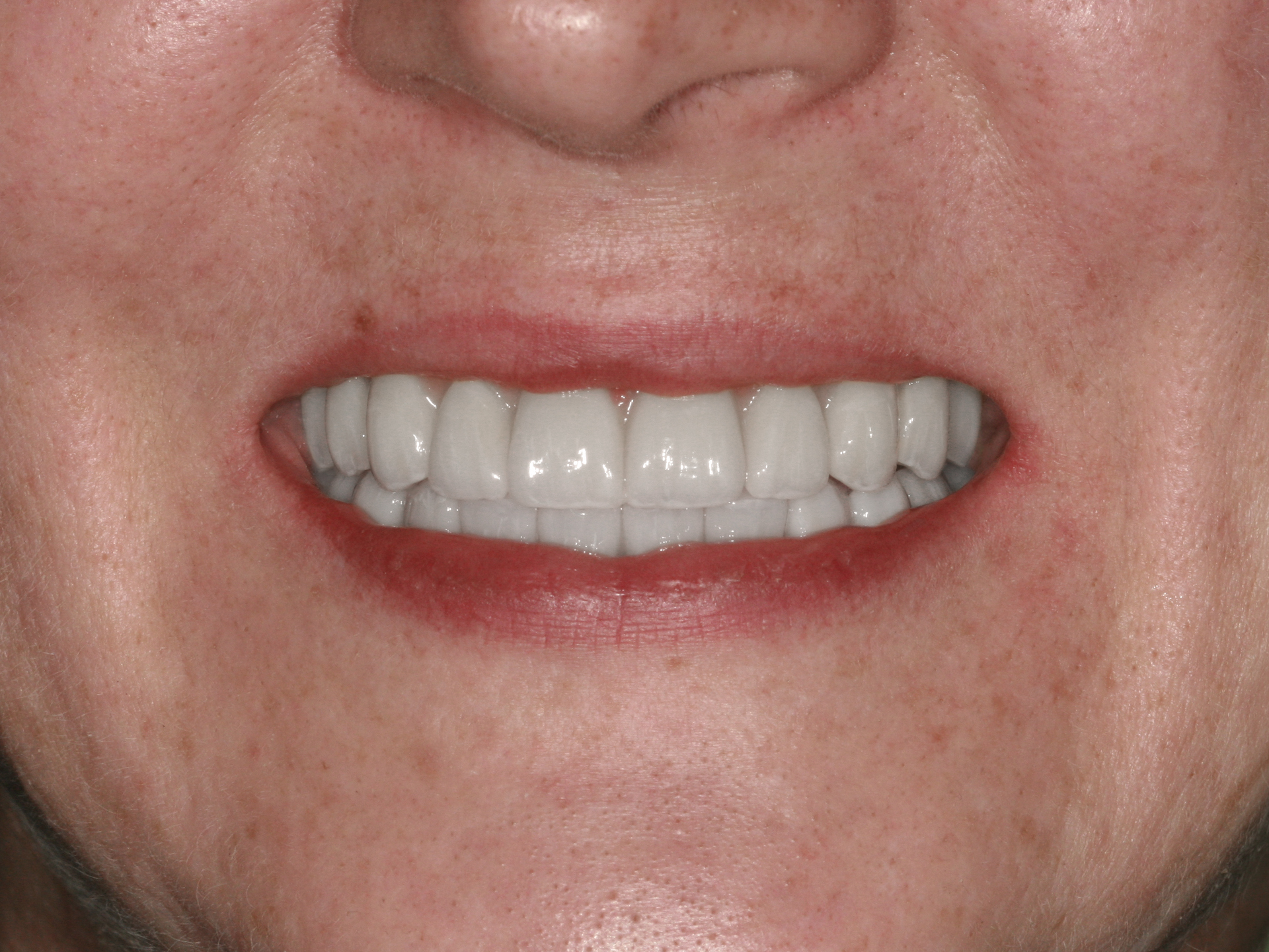 Dental Implant After: Dr. Craig Horton Envision Greenville, SC