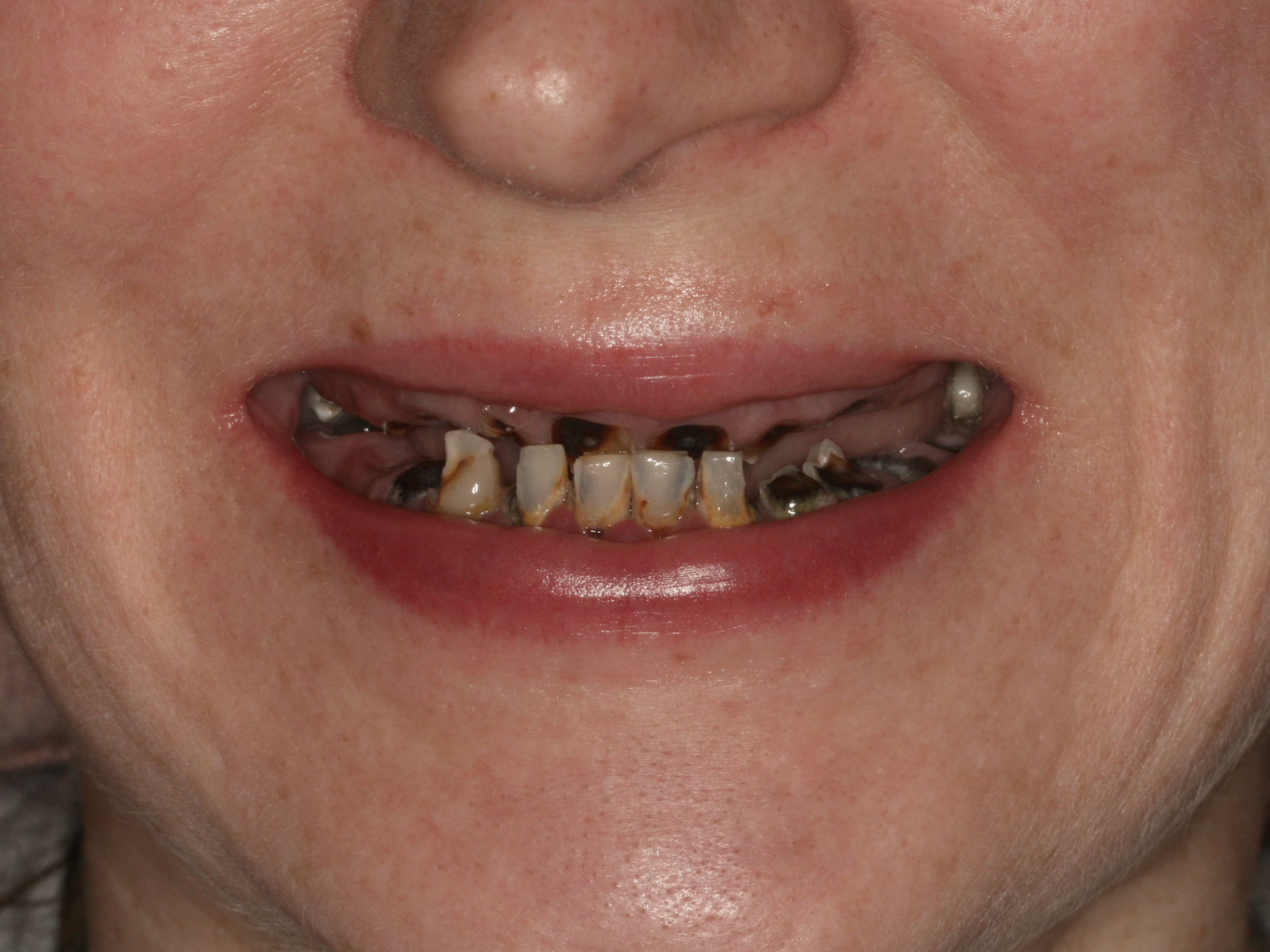 Dental Implant Before: Dr. Craig Horton Envision Greenville, SC