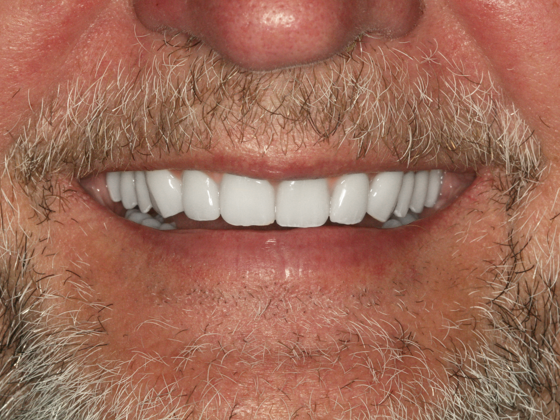 Dental Implant After: Dr. Craig Horton Envision Greenville, SC