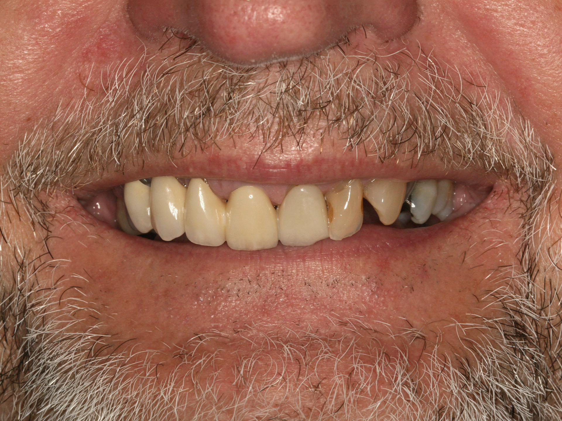 Dental Implant Before: Dr. Craig Horton Envision Greenville, SC