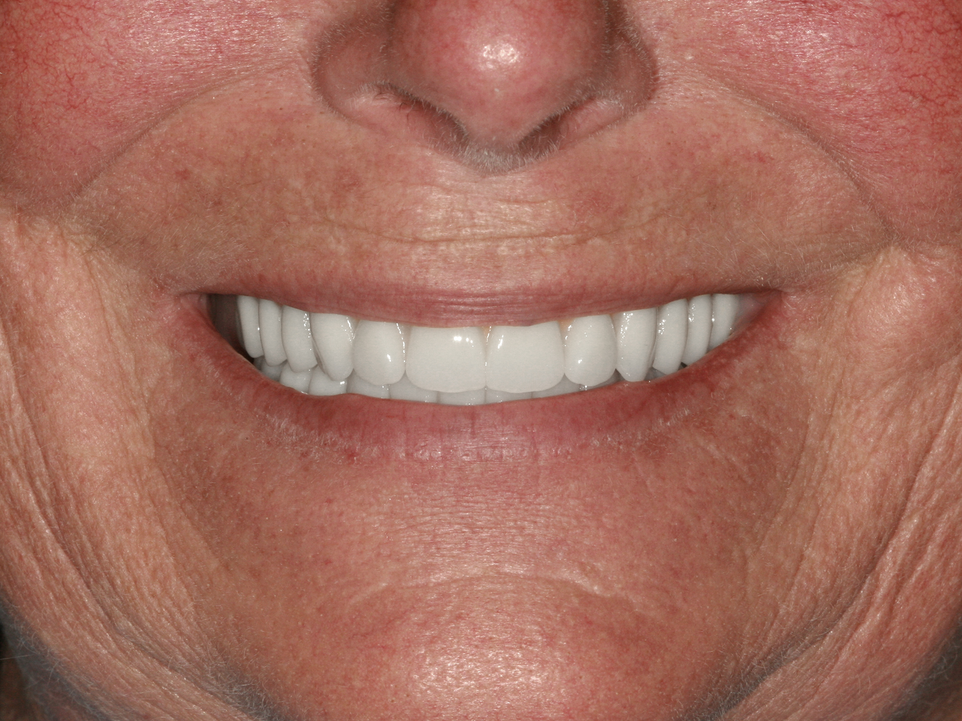 Dental Implant After: Dr. Craig Horton Envision Greenville, SC