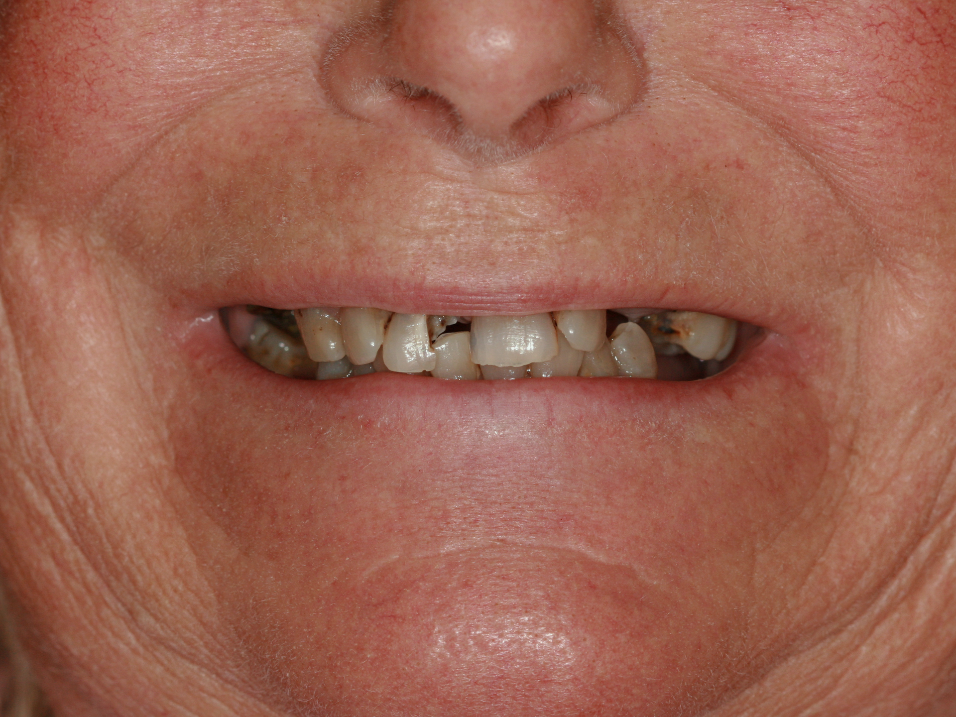 Dental Implant Before: Dr. Craig Horton Envision Greenville, SC