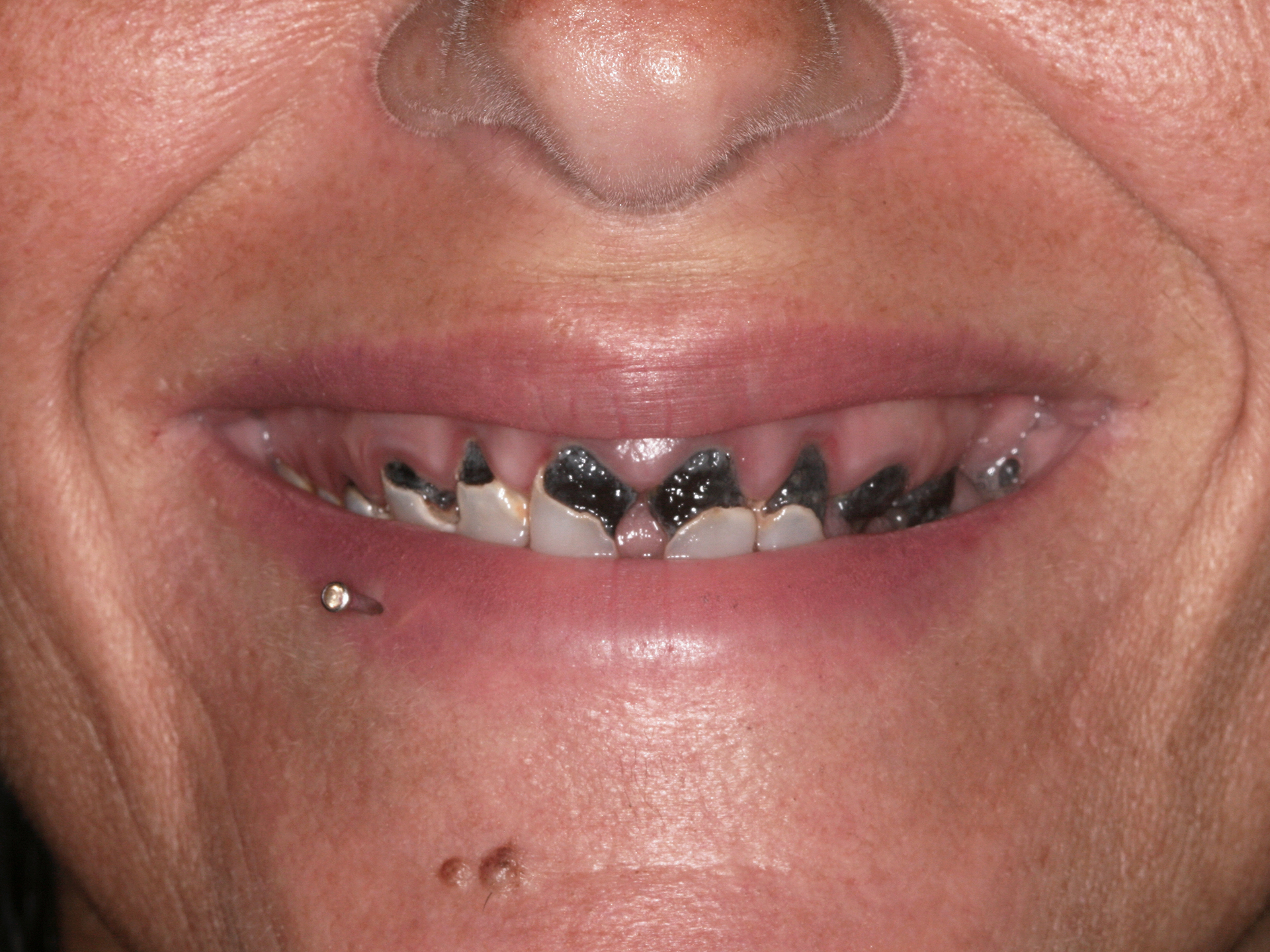 Dental Implant Before: Dr. Craig Horton Envision Greenville, SC