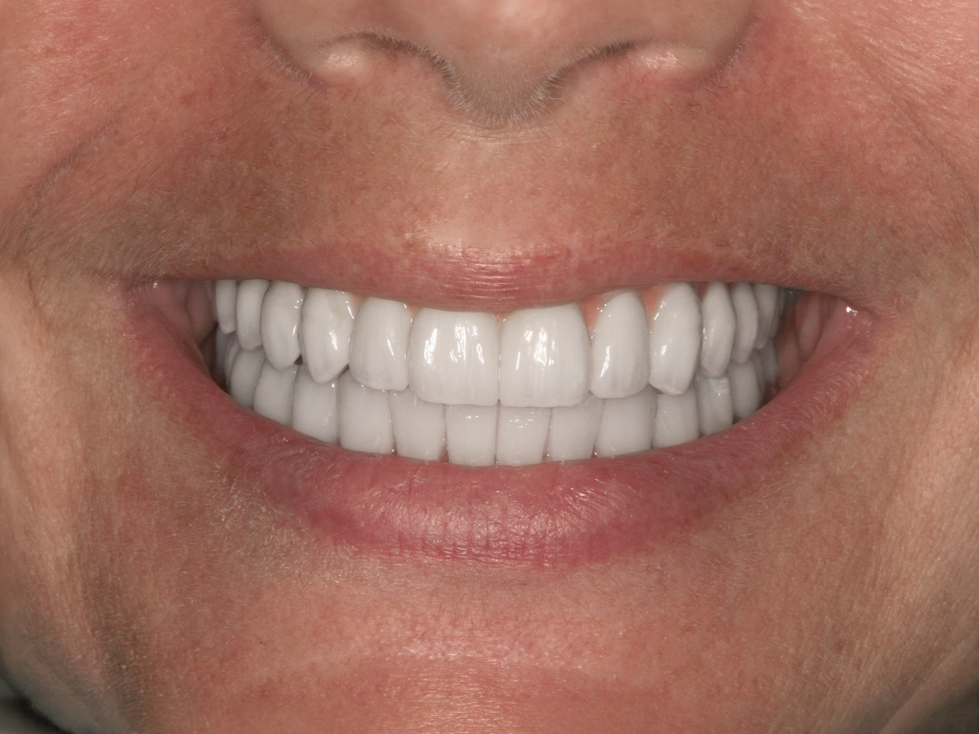 Dental Implant After: Dr. Craig Horton Envision Greenville, SC