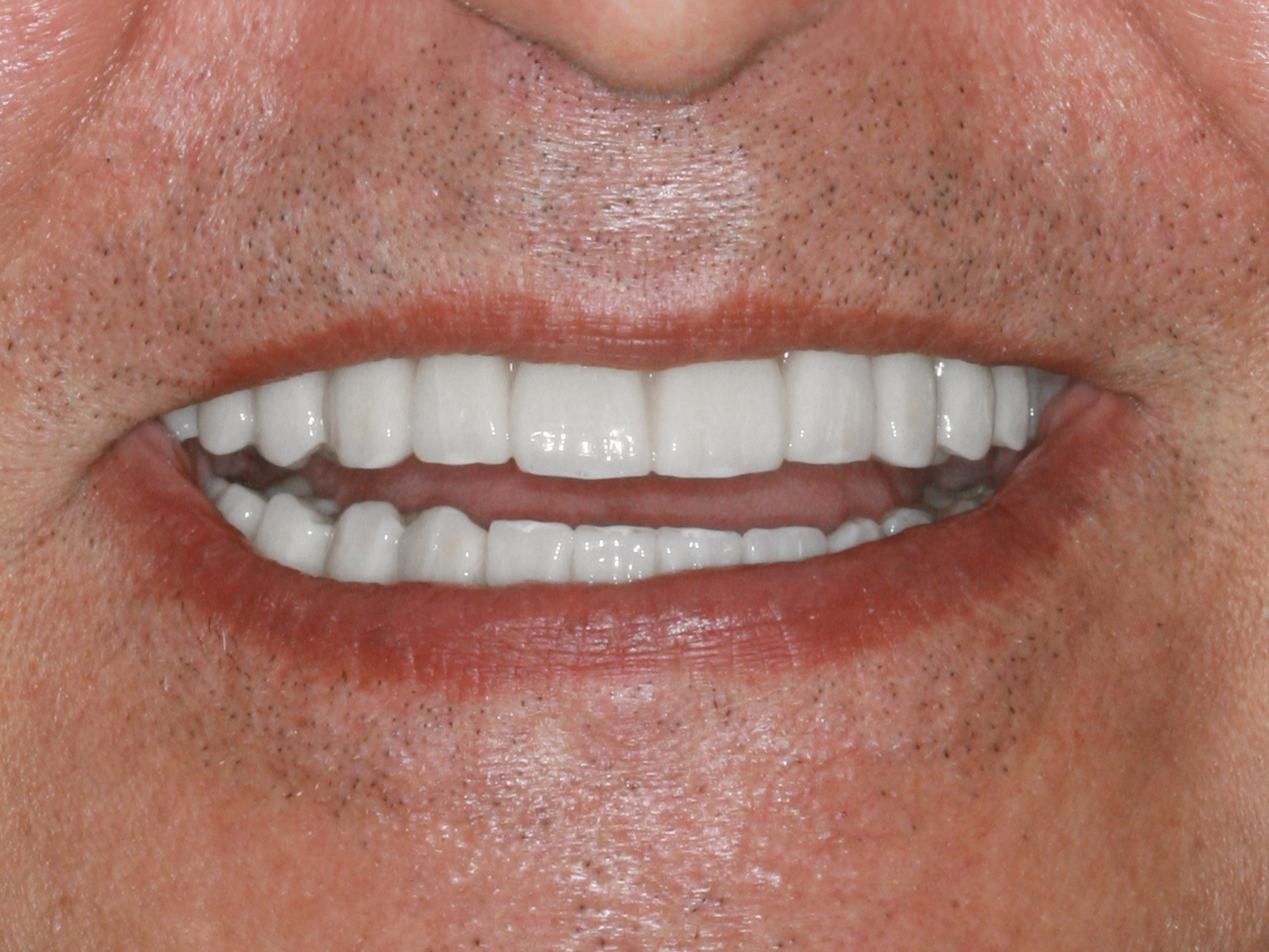 Dental Implant After: Dr. Craig Horton Envision Greenville, SC
